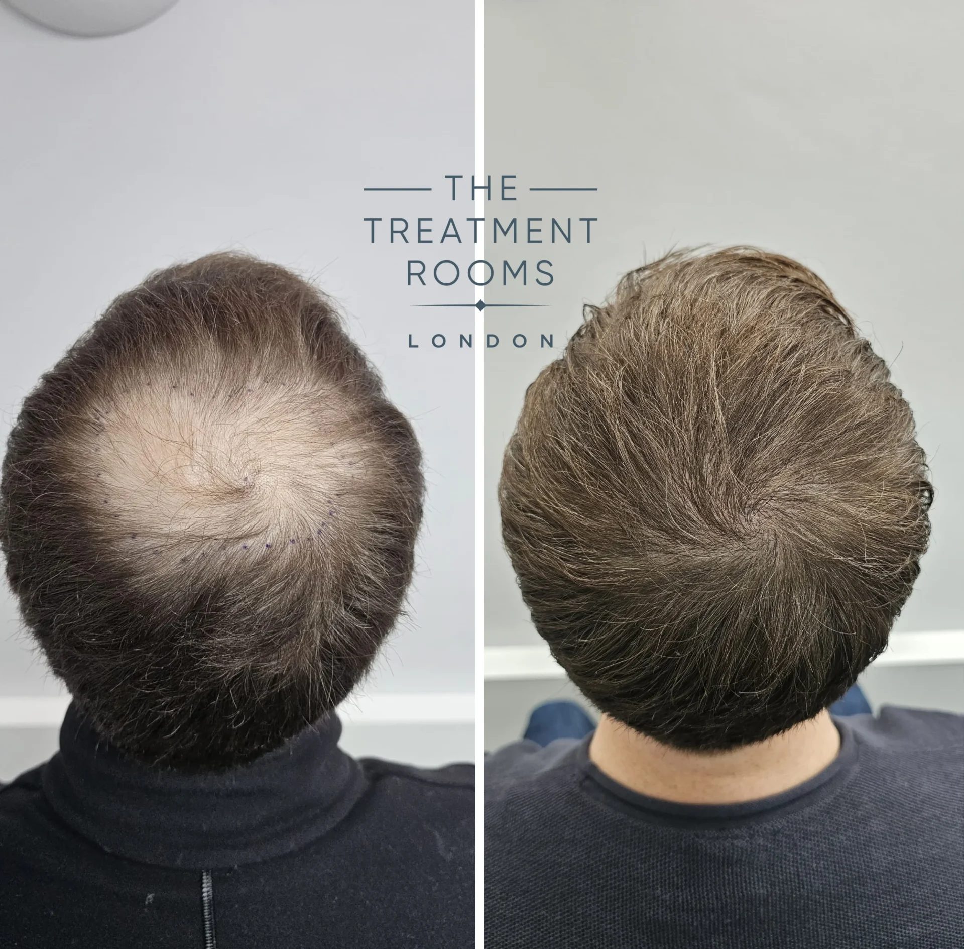 Best FUE Crown Hair Transplant Before and After 1380 grafts