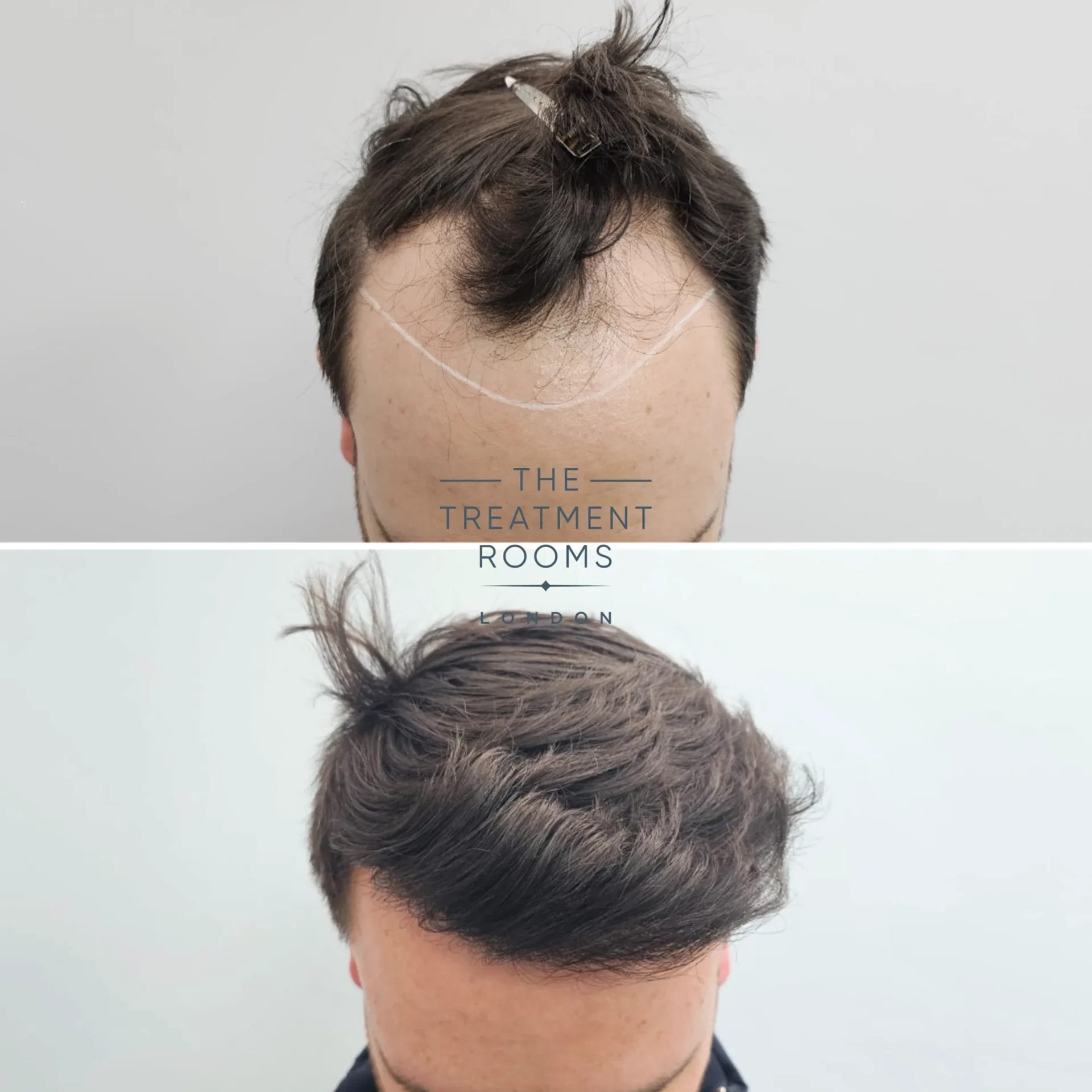 Best fue hair transplant before and after 2247 grafts