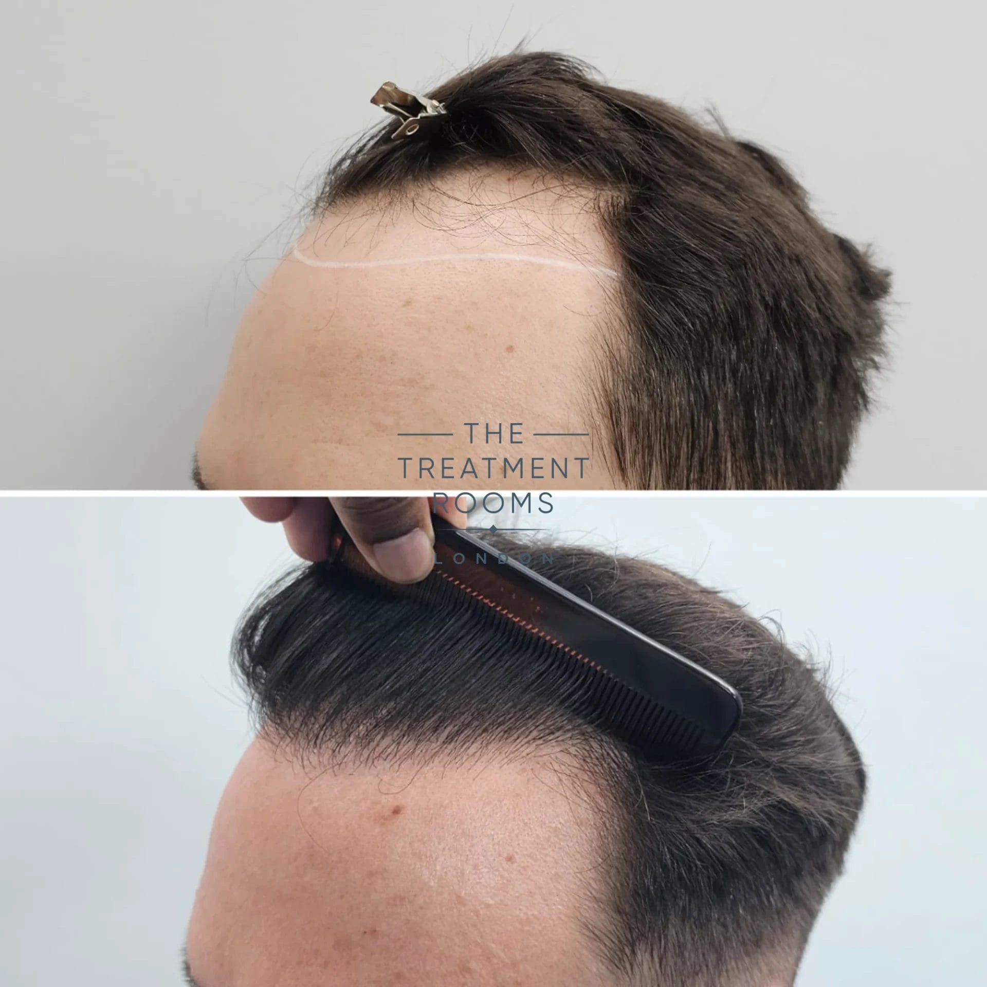 Best hairline hair transplant clinic London before and after 2247 grafts