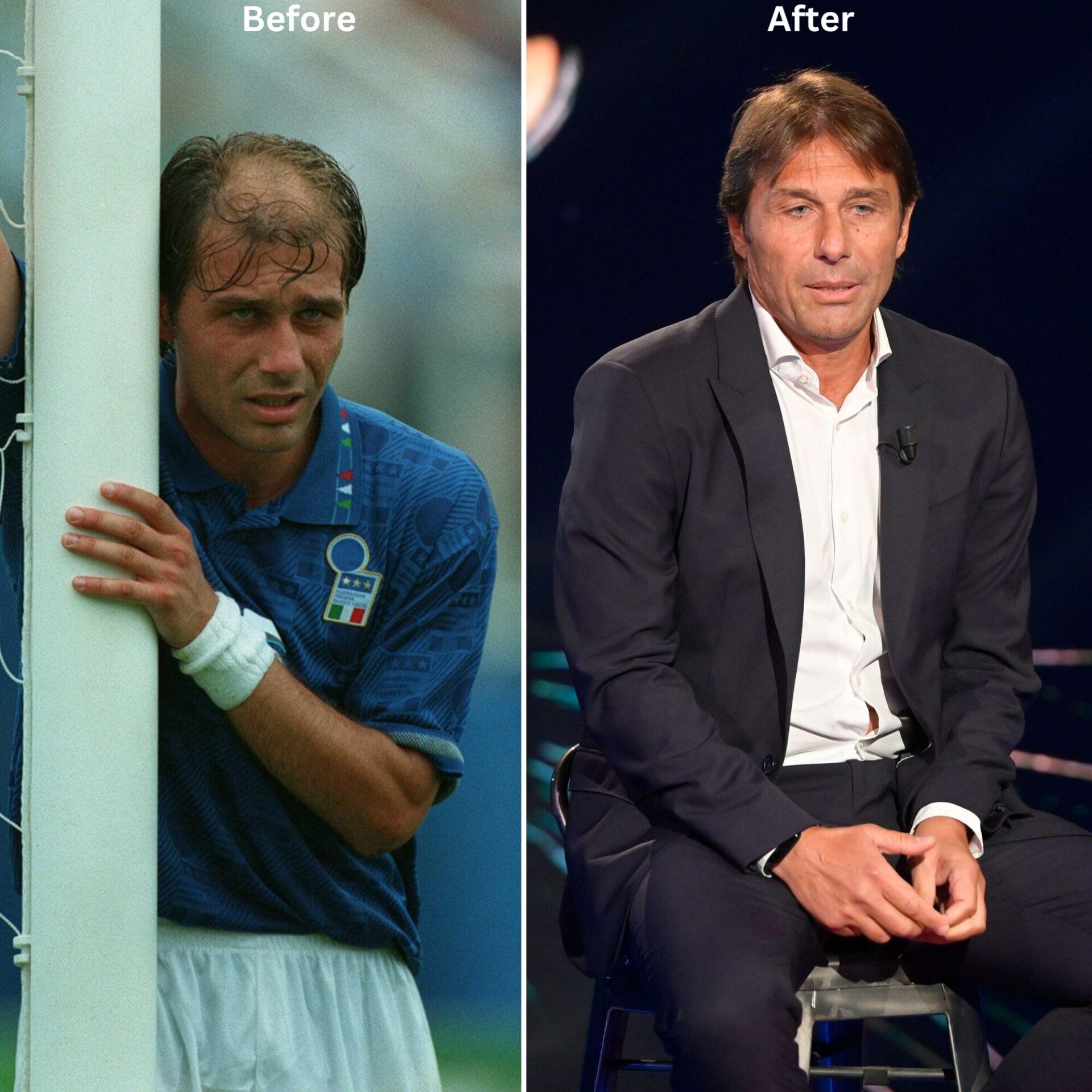 antonio conte hair transplant