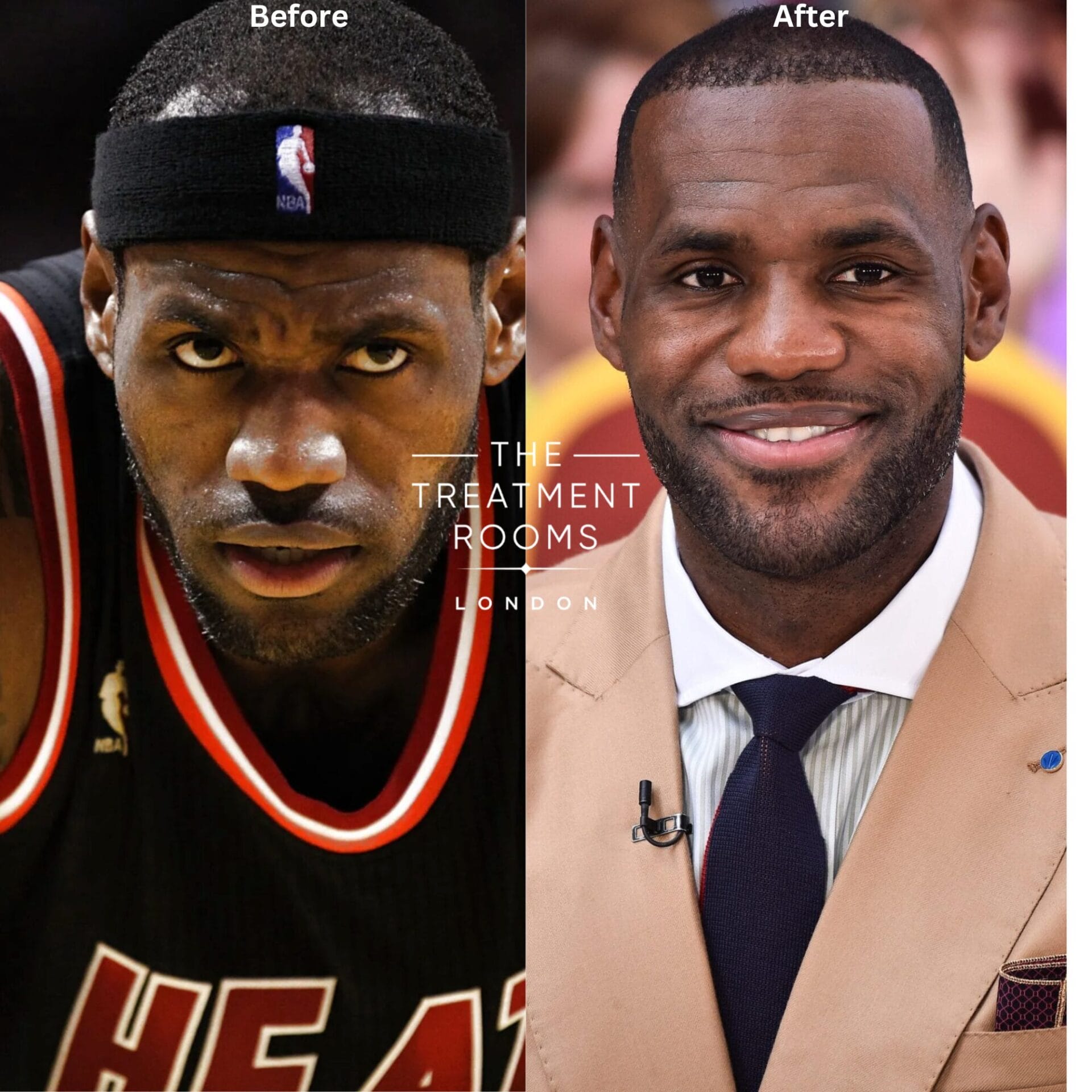 lebron james hair transplant before and after