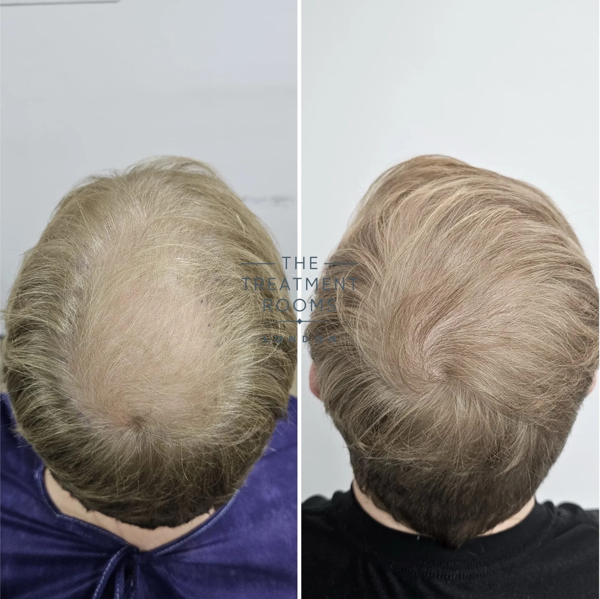 Crown fue hair transplant before and after 2014 grafts