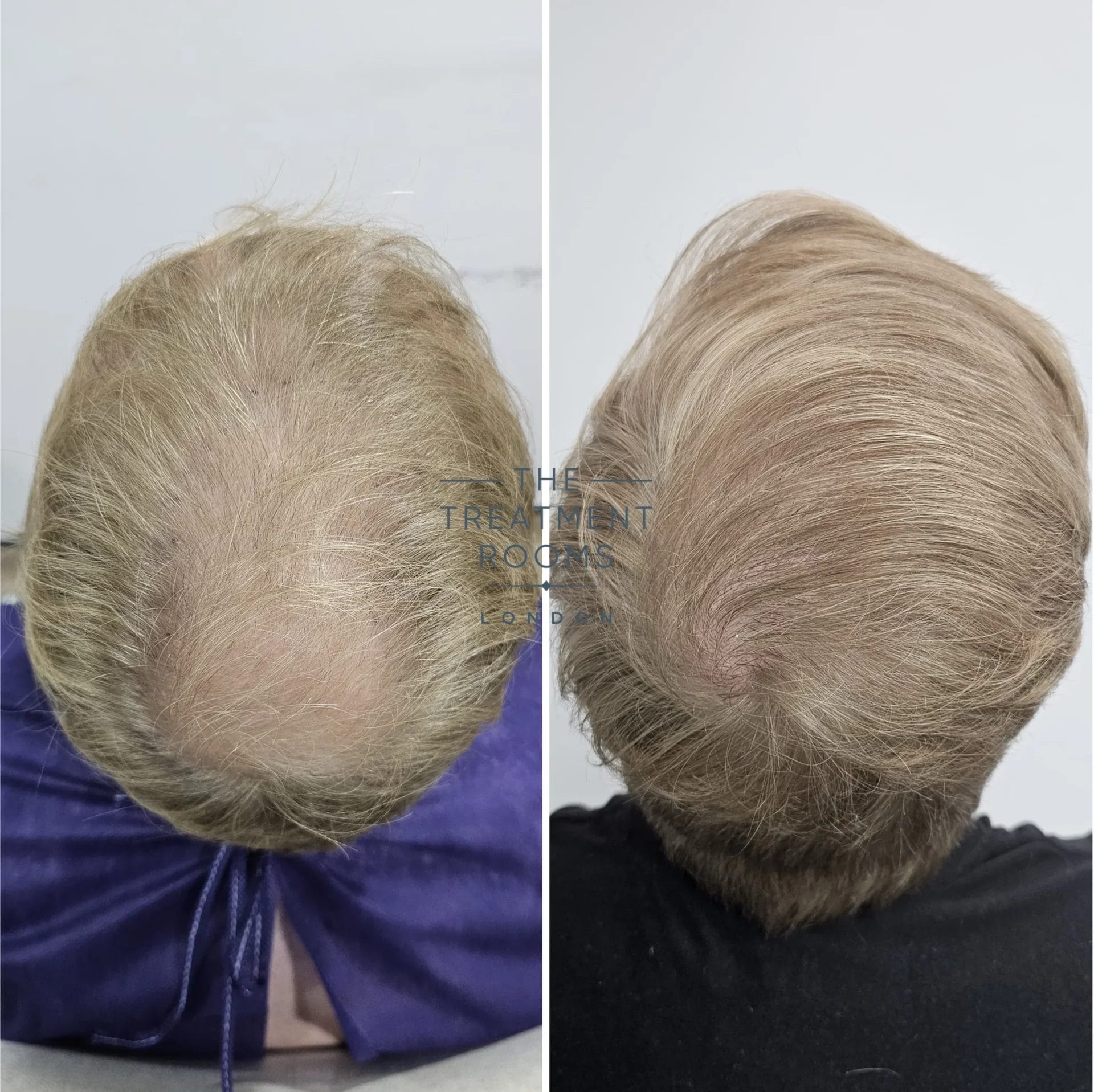 Crown hair transplant before and after 2014 grafts