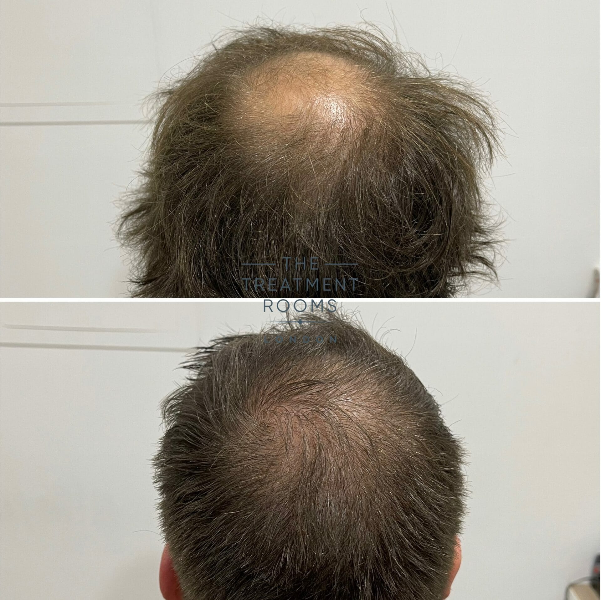 Crown transplant before and after Crown transplant before and after