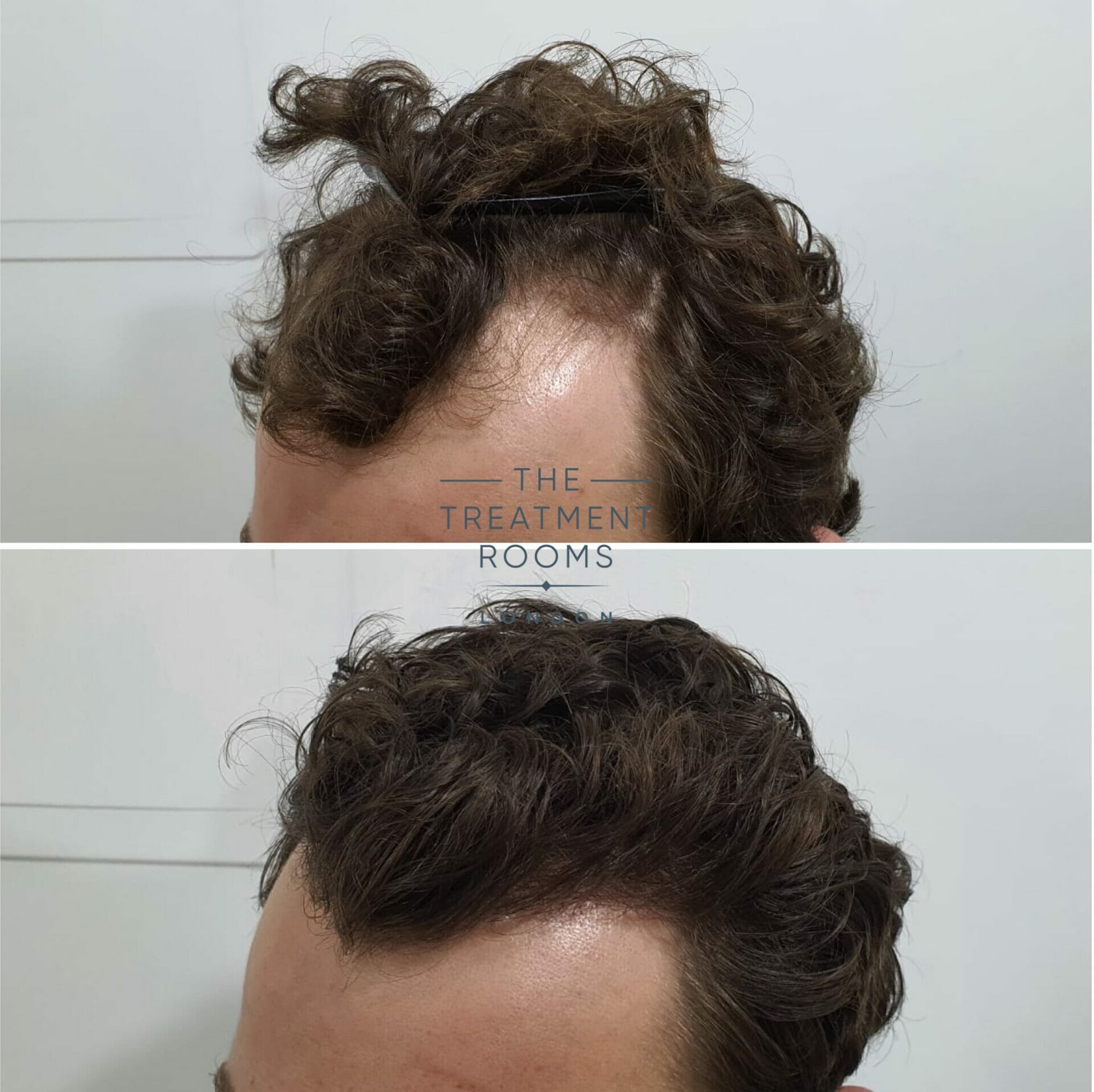 Curly hair FUE hair transplant 1243 grafts result Curly hair FUE hair transplant 1243 grafts result