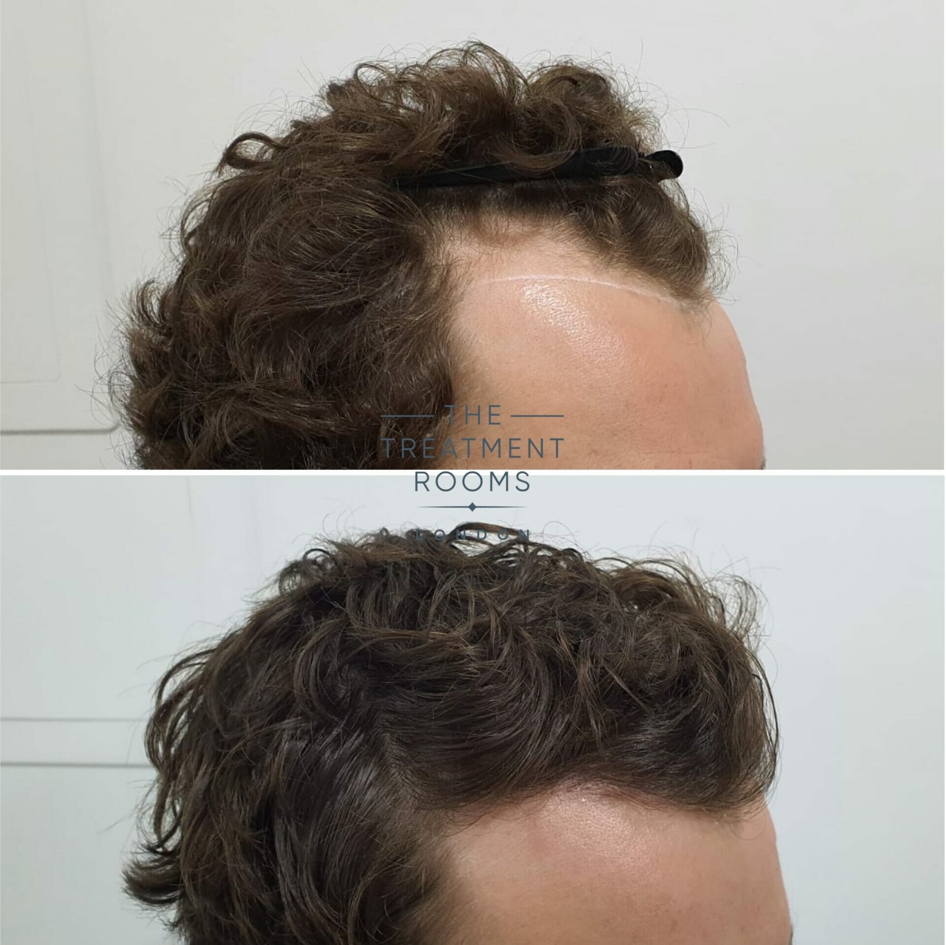 Curly hair thinning on top best sale