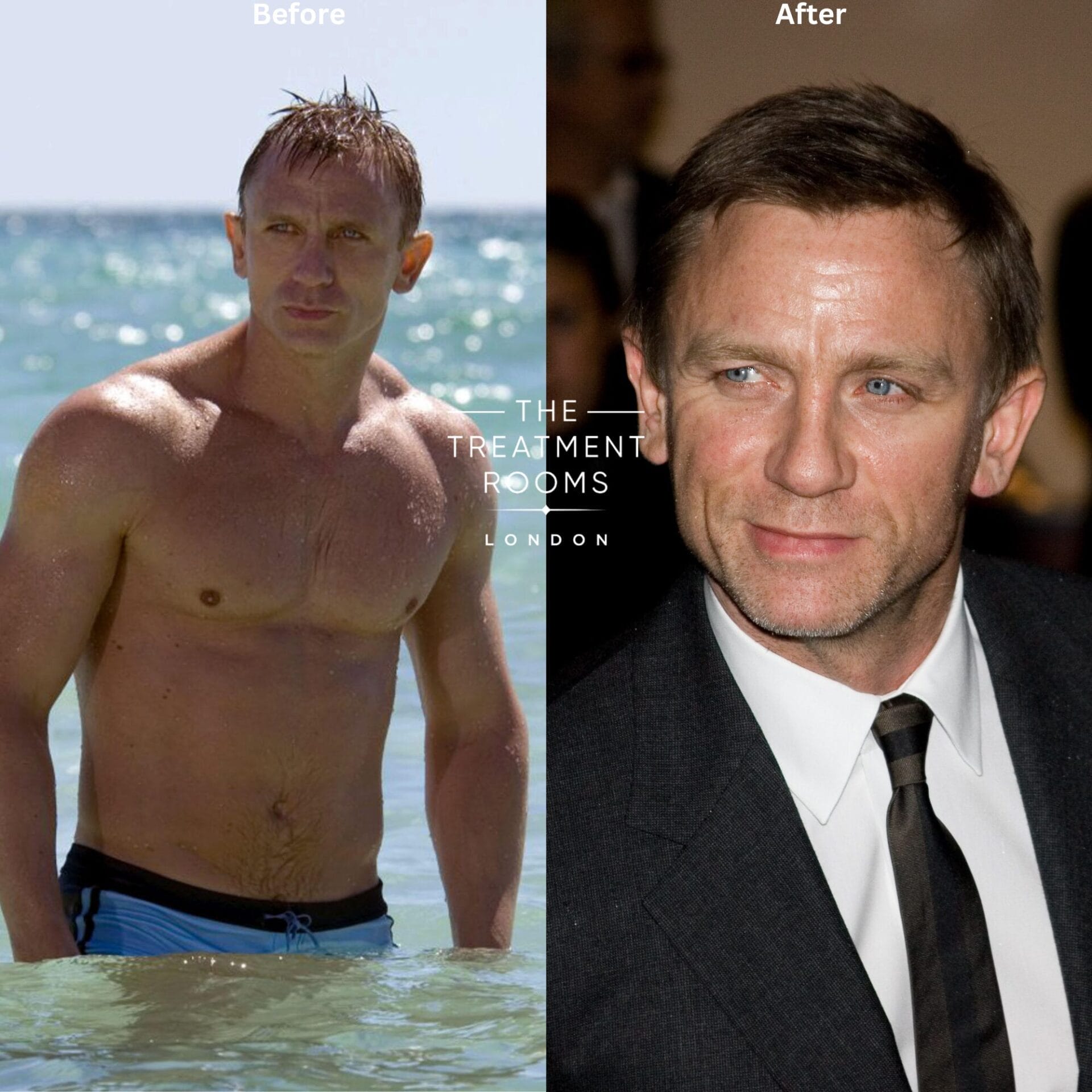 daniel craig before and after hair transplant