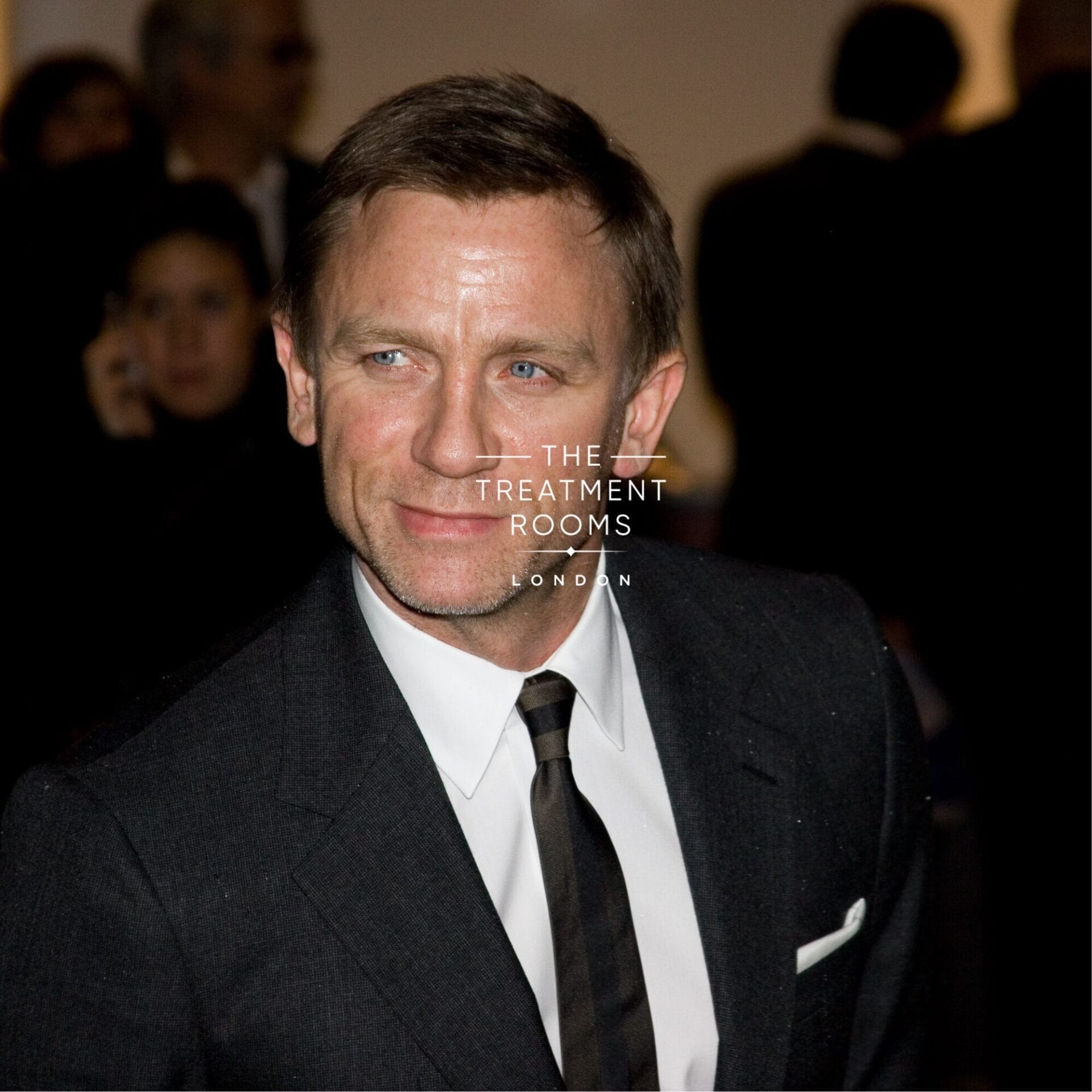 daniel craig after hair transplant
