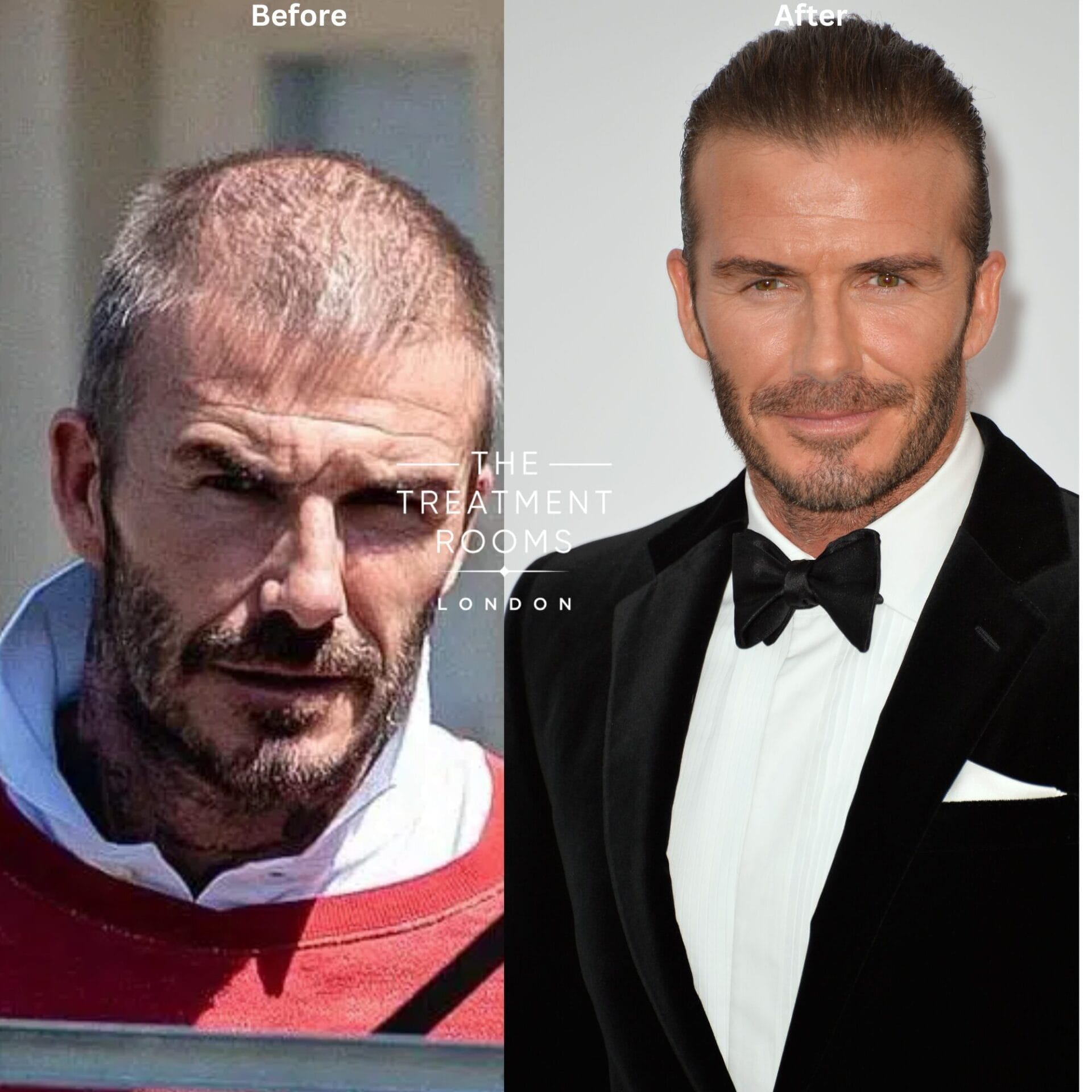 david hair transplant before and after