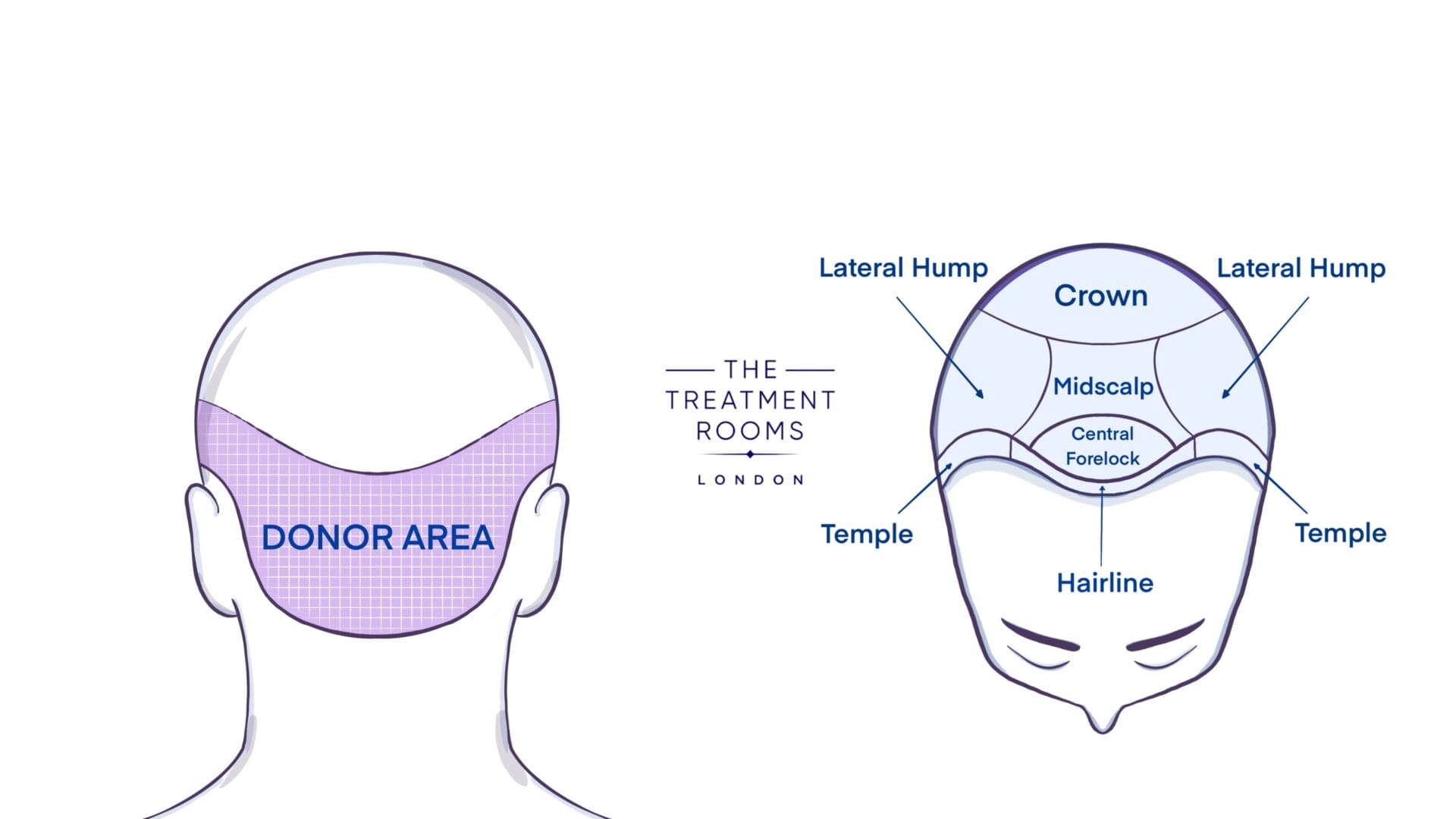 Donor and Recipient Areas