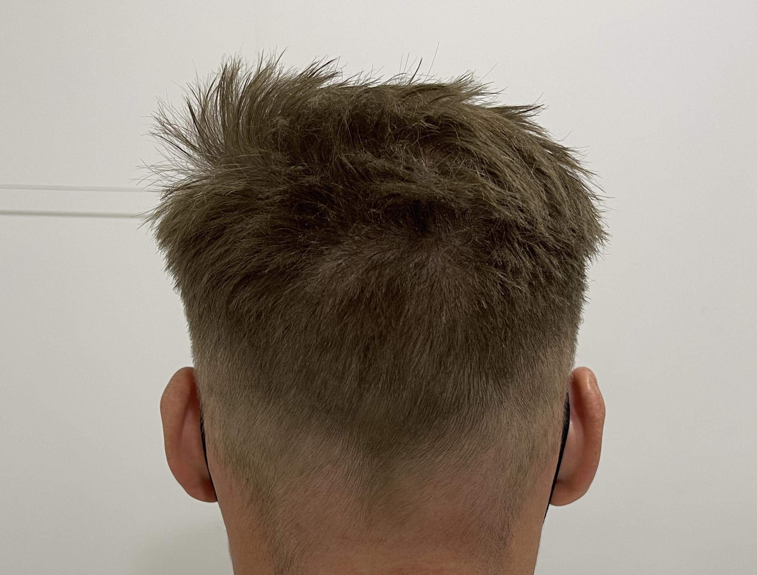 Donor-area-scars-after-hair-transplant-surgery donor area scars after hair transplant