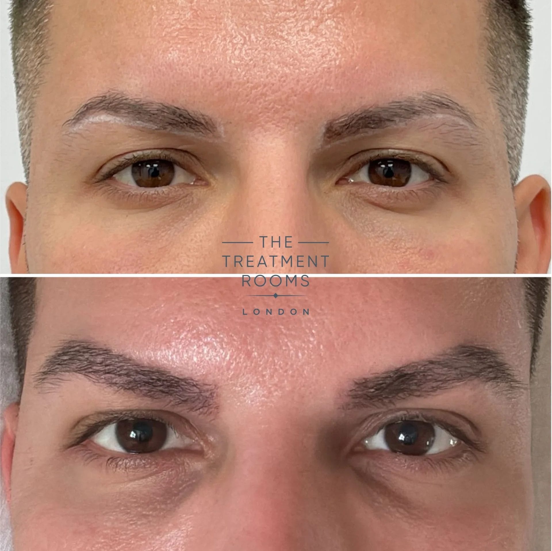 Eyebrow hair transplant london