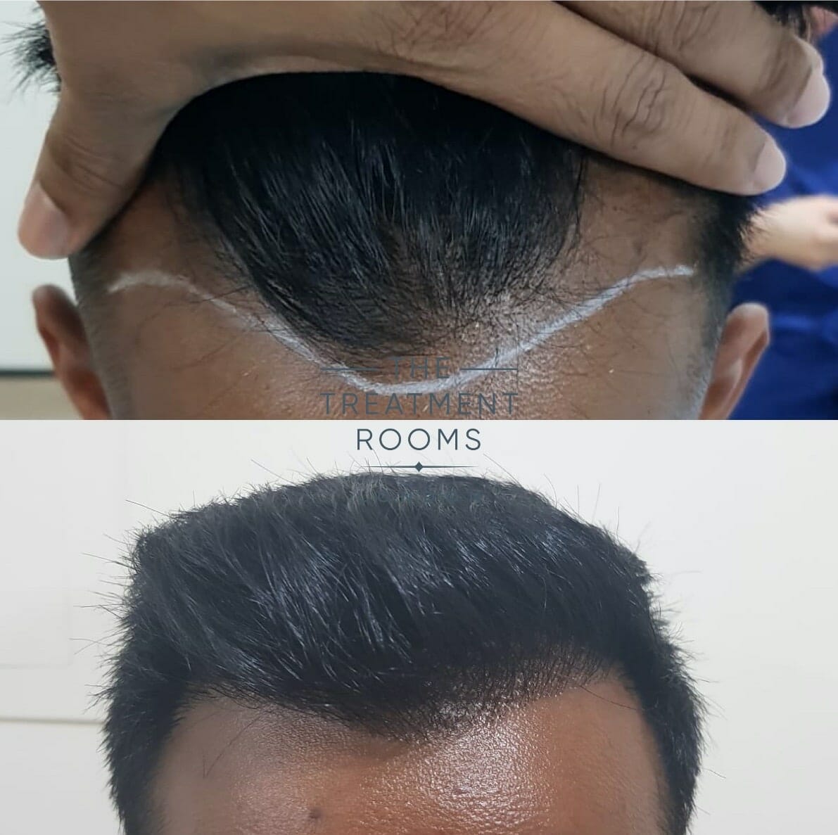 FUE-Hair-Transplant-Hairline hairline hair transplant result