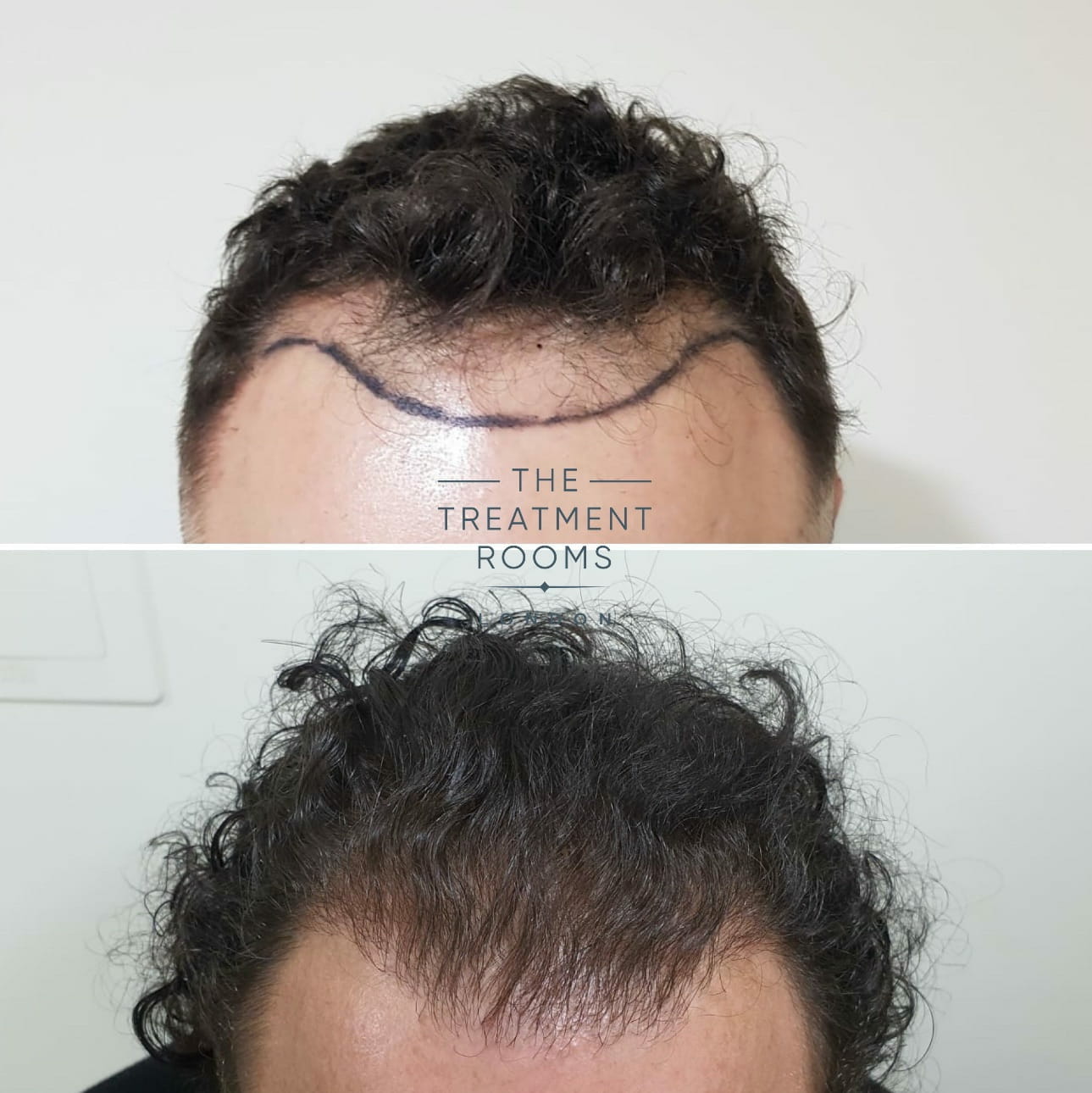 FUE Hair Transplant Hairline Front Wavy Hair FUE Hair Transplant Hairline Front Wavy Hair