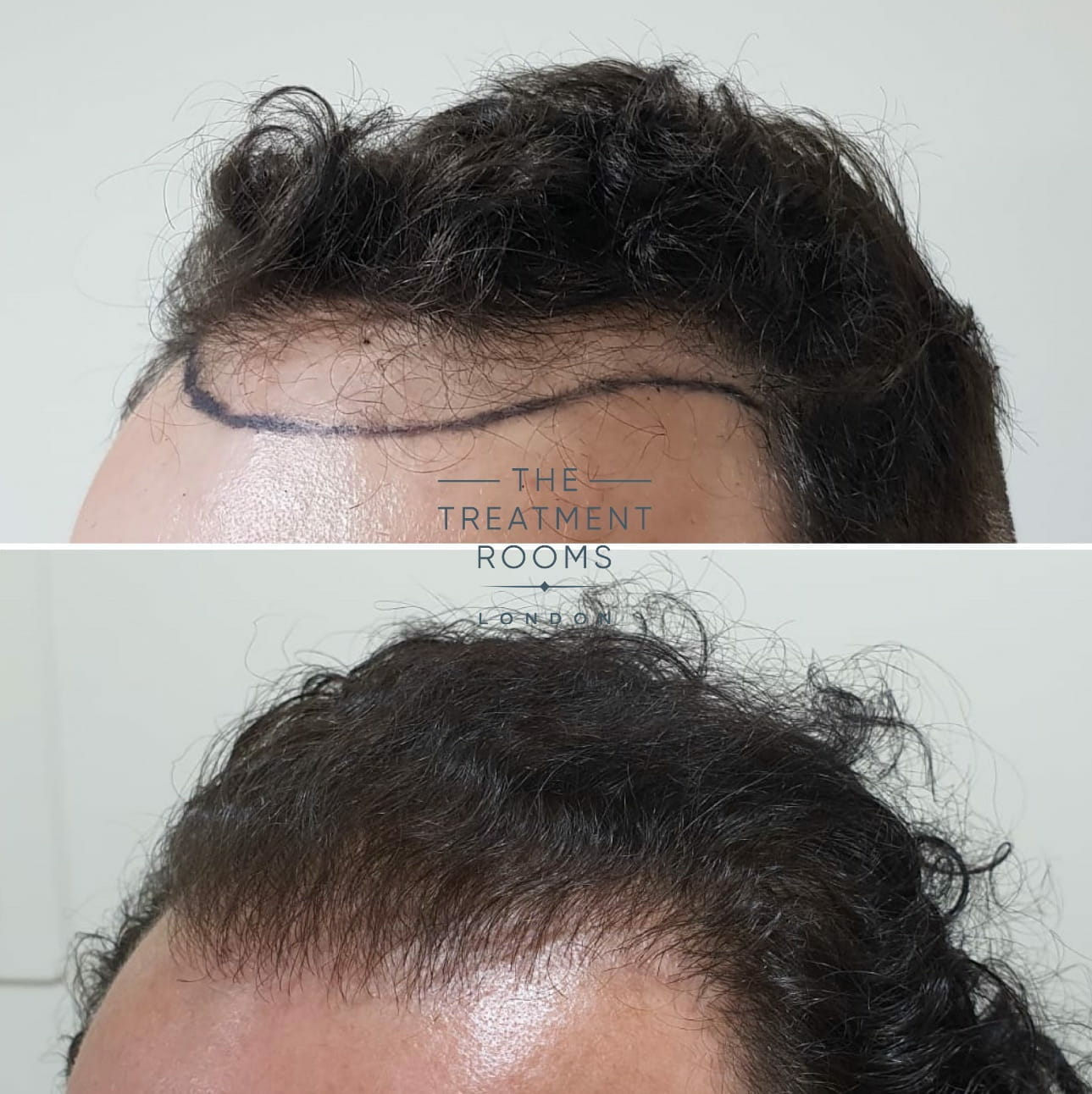 fue hair transplant wavy hair