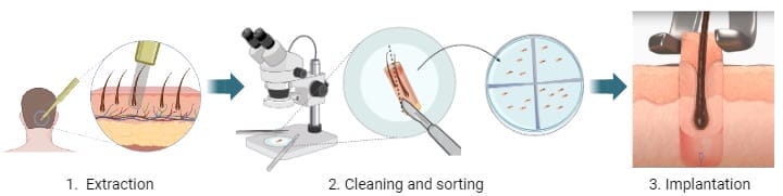 diagram explain how grafts are used in hair transplant surgery