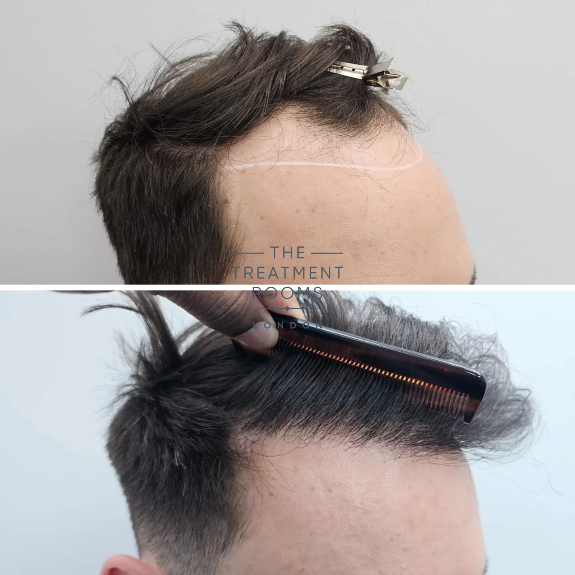 FUE Hairline hair transplant before and after 2247 grafts