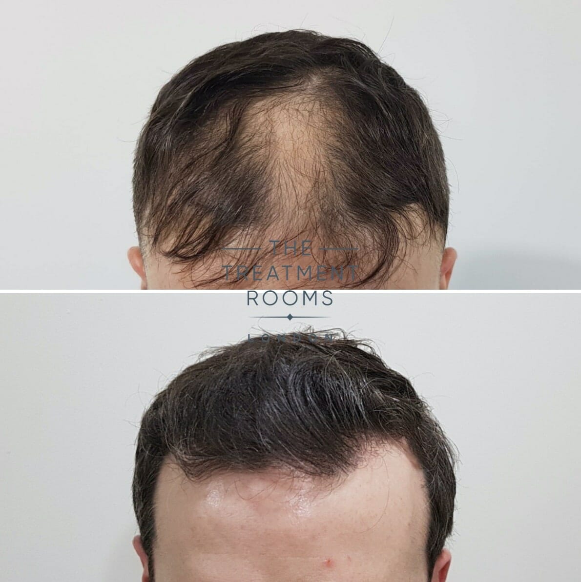 FUE hair transplant before after