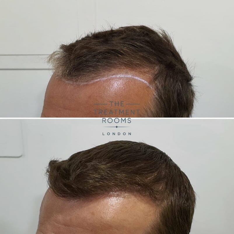 FUE hair transplant hairline 1452 grafts FUE hair transplant hairline 1452 grafts