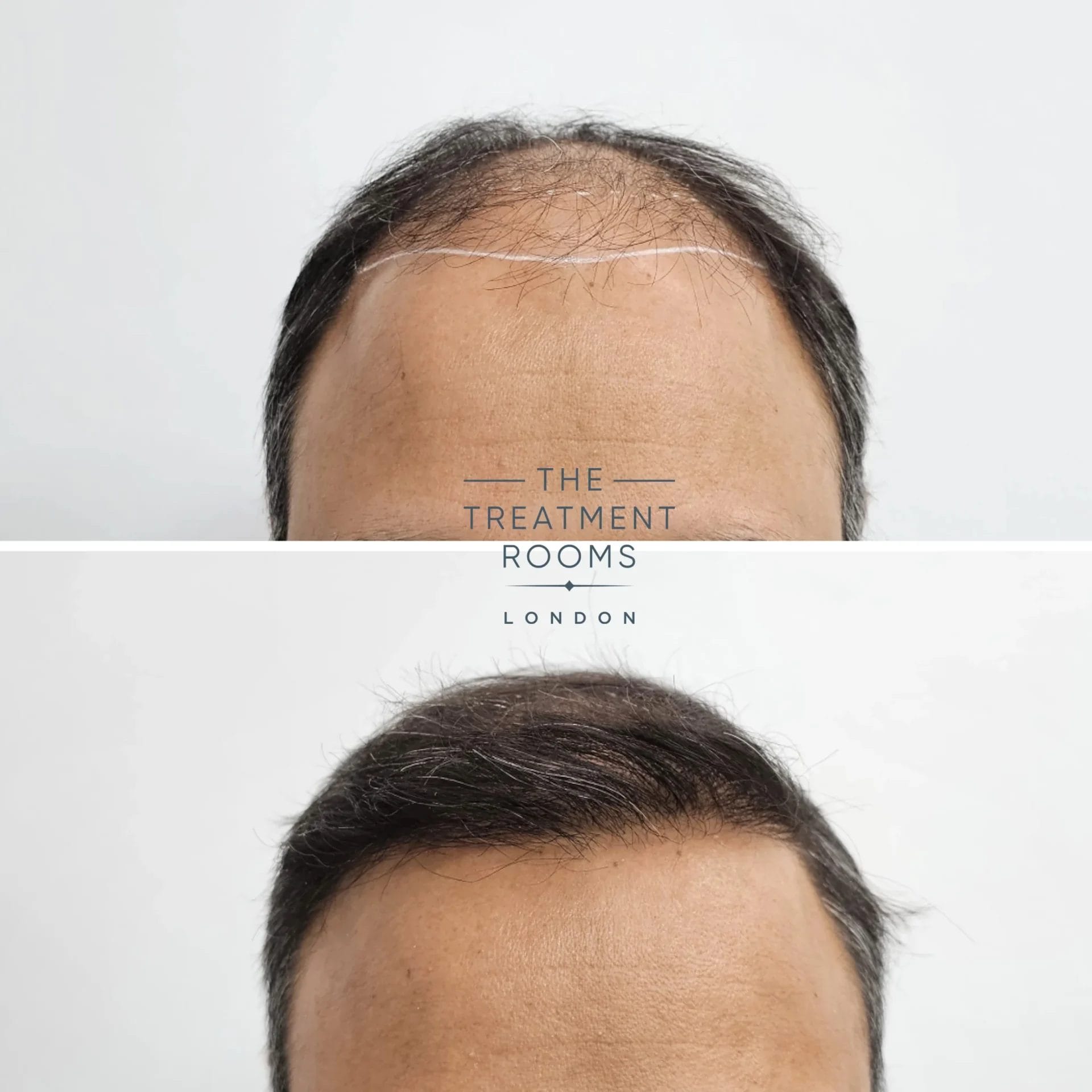 FUE hair transplant hairline before after 2067 grafts