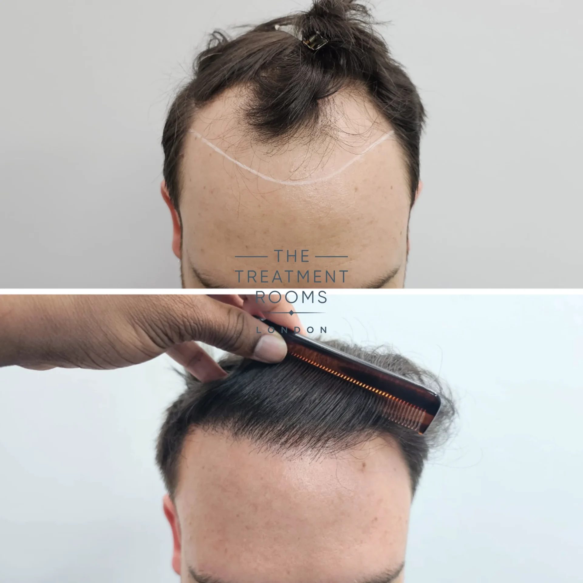 FUE hair transplant hairline before after 2247 grafts