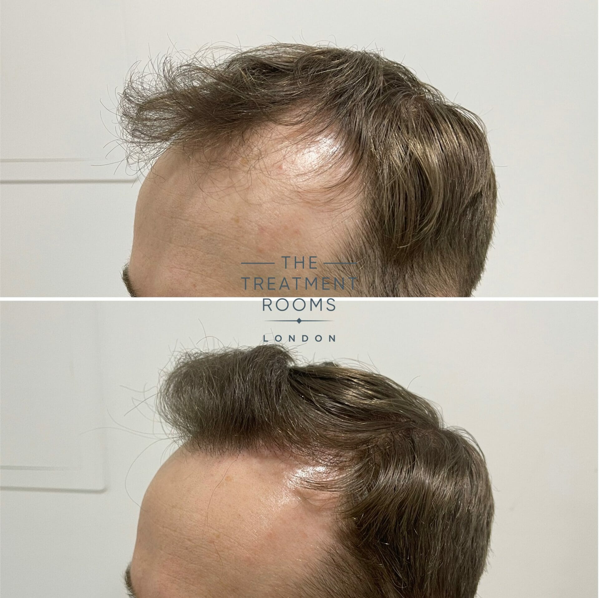 FUE hair transplant london before and after