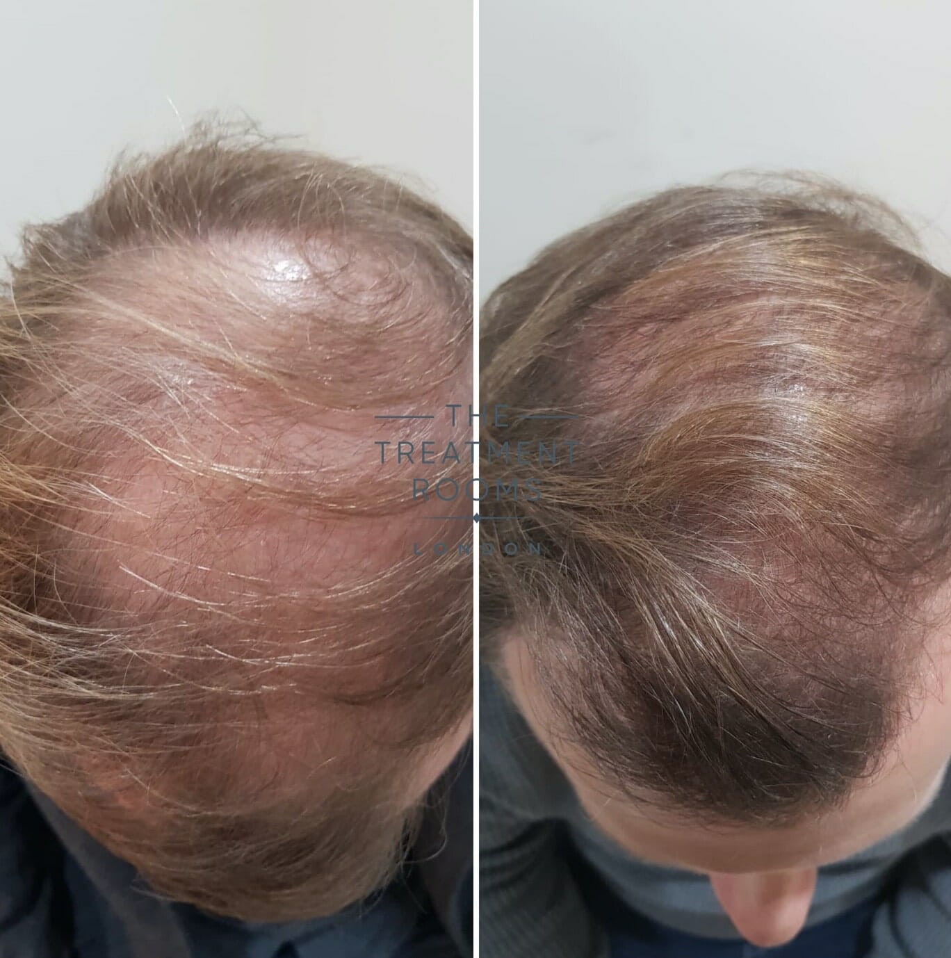 FUE hair transplant result london