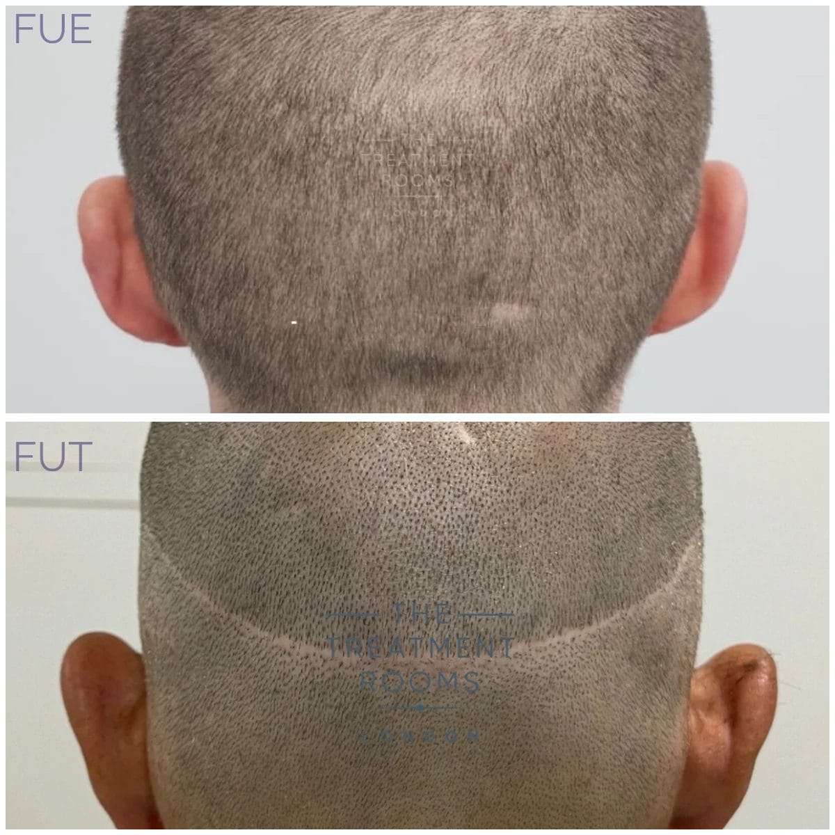 A comparison of scarring from an FUE (leaving tiny dot-like scars) surgery, and FUT surgery (leaving a linear scar).