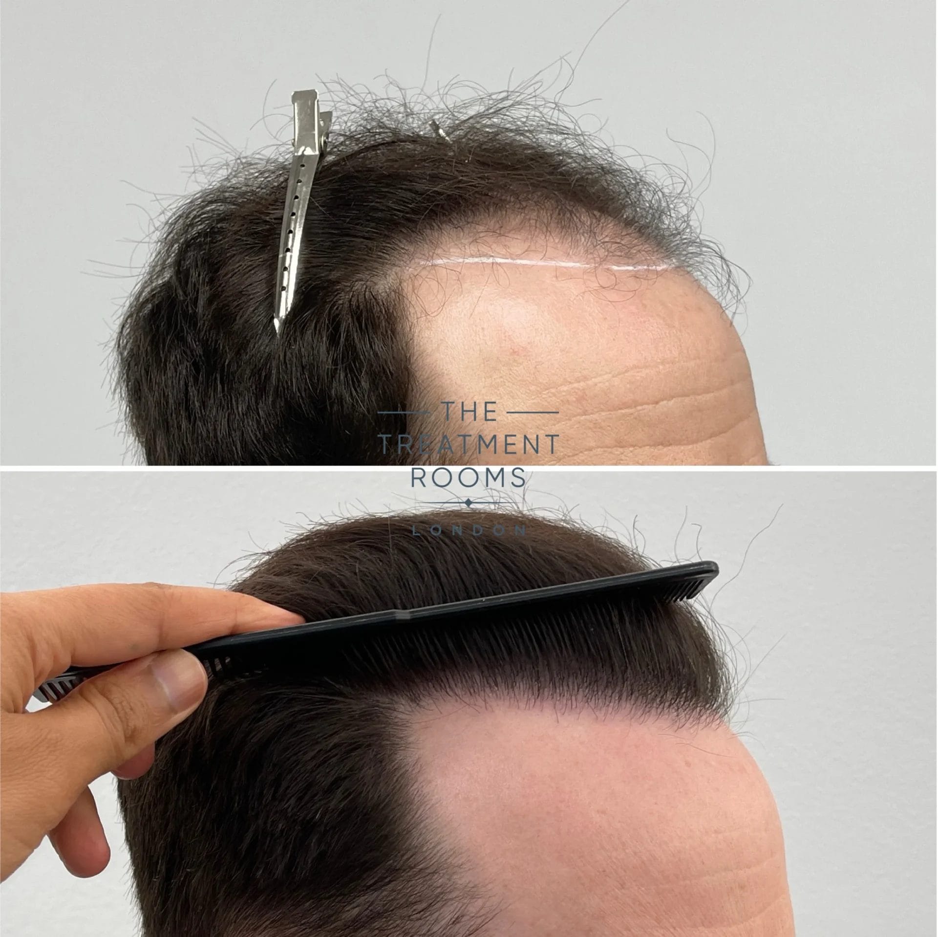 FUT hair transplant crown
