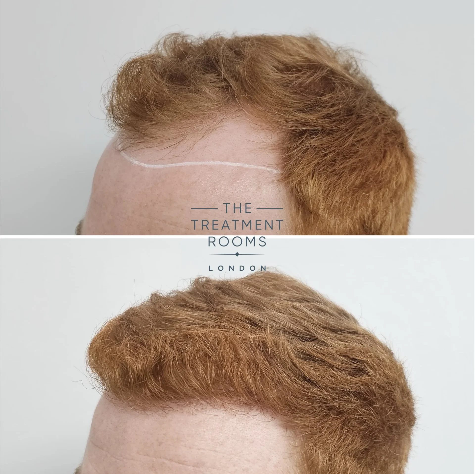 FUT hair transplant london
