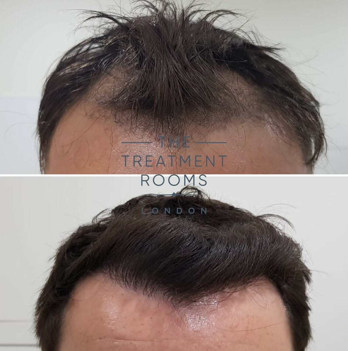 Frontal-Hairline-Hair-Transplant frontal hairline hair transplant london
