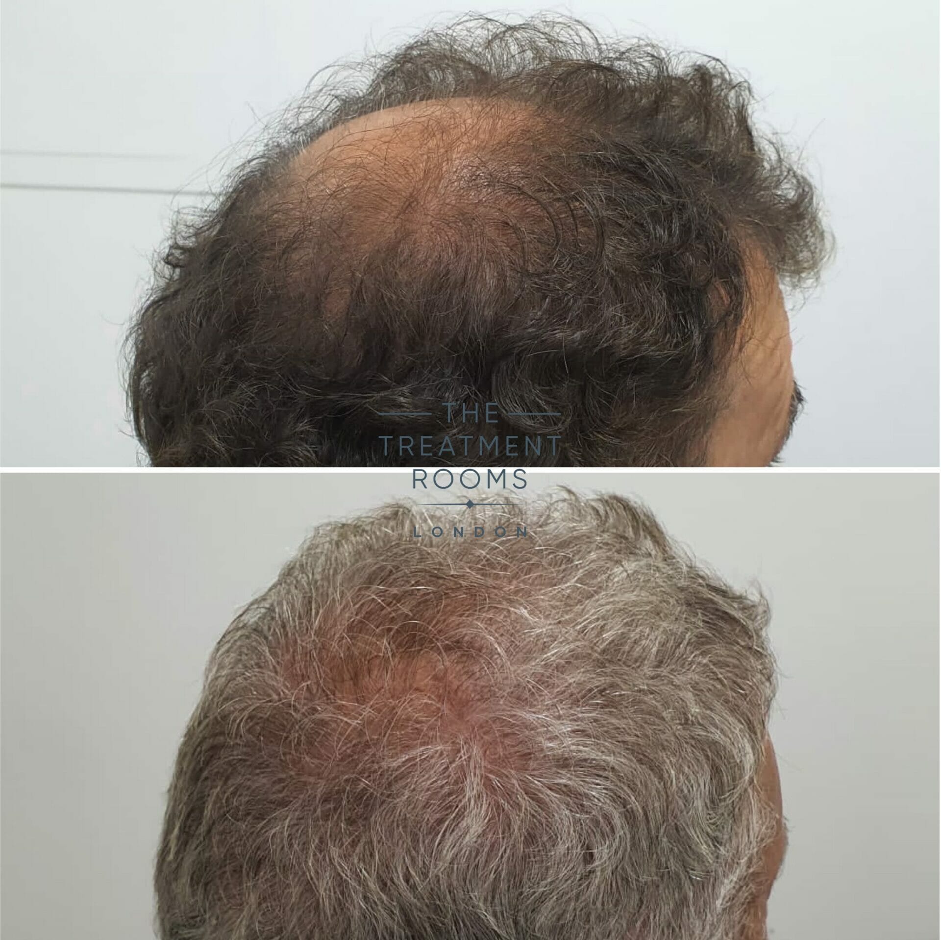 Grey hair crown transplant 2110 grafts Grey hair crown transplant 2110 grafts