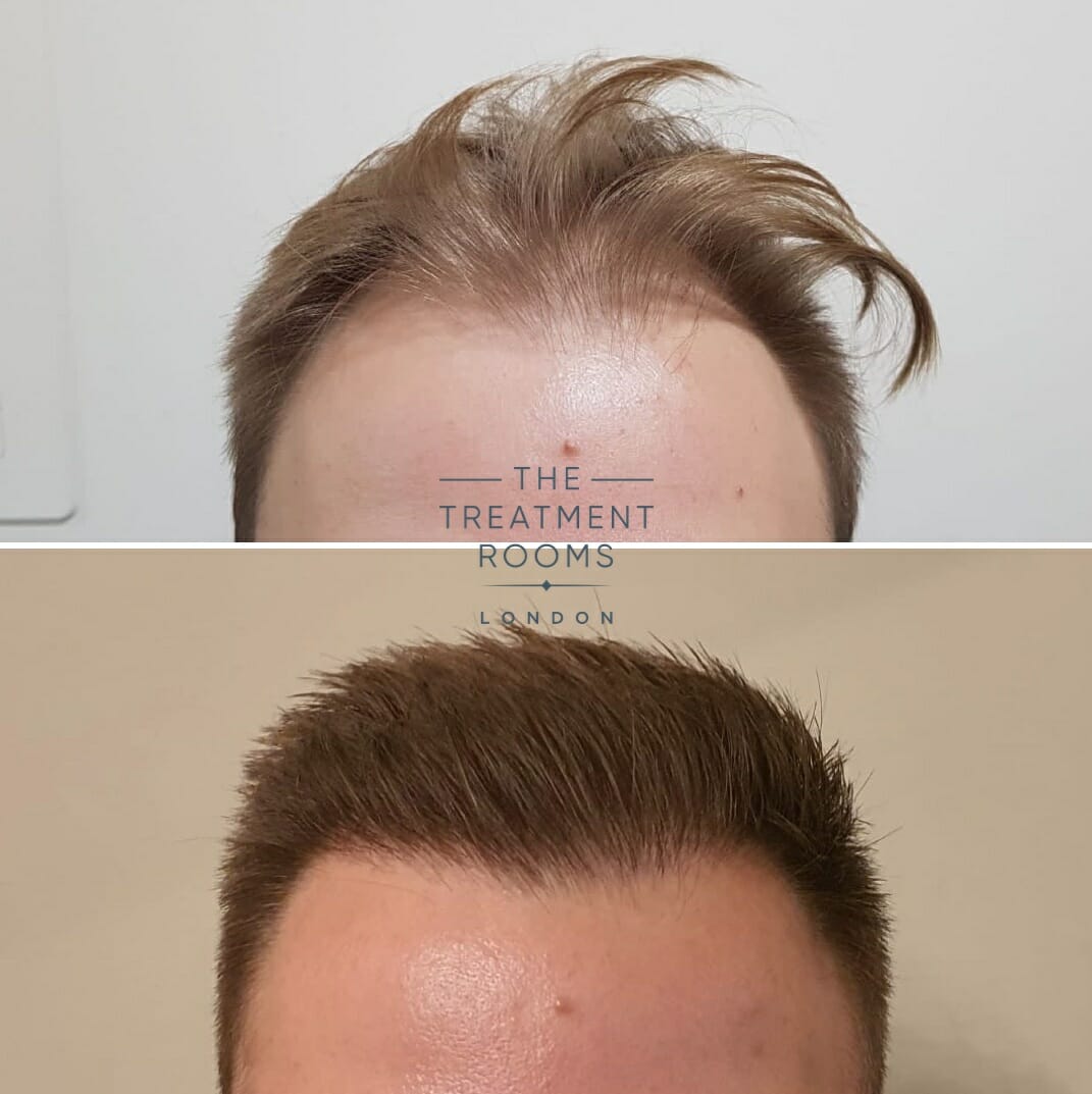 Hair Transplant hairline