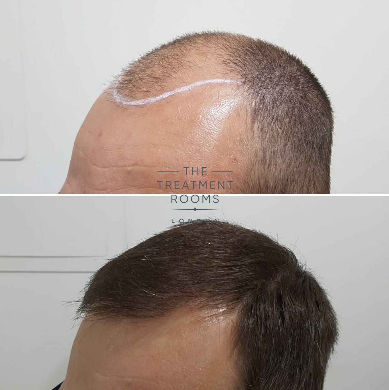 Hair transplant before and after