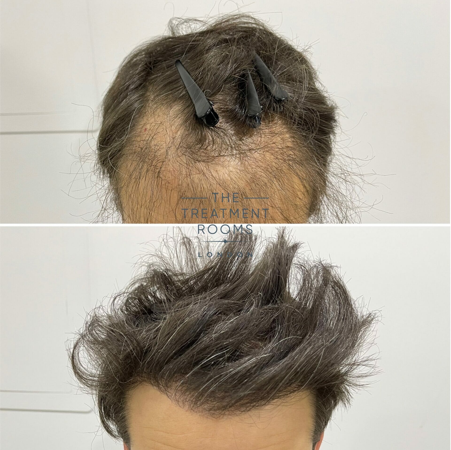 Hair transplant repair london fue Hair transplant repair london before and after