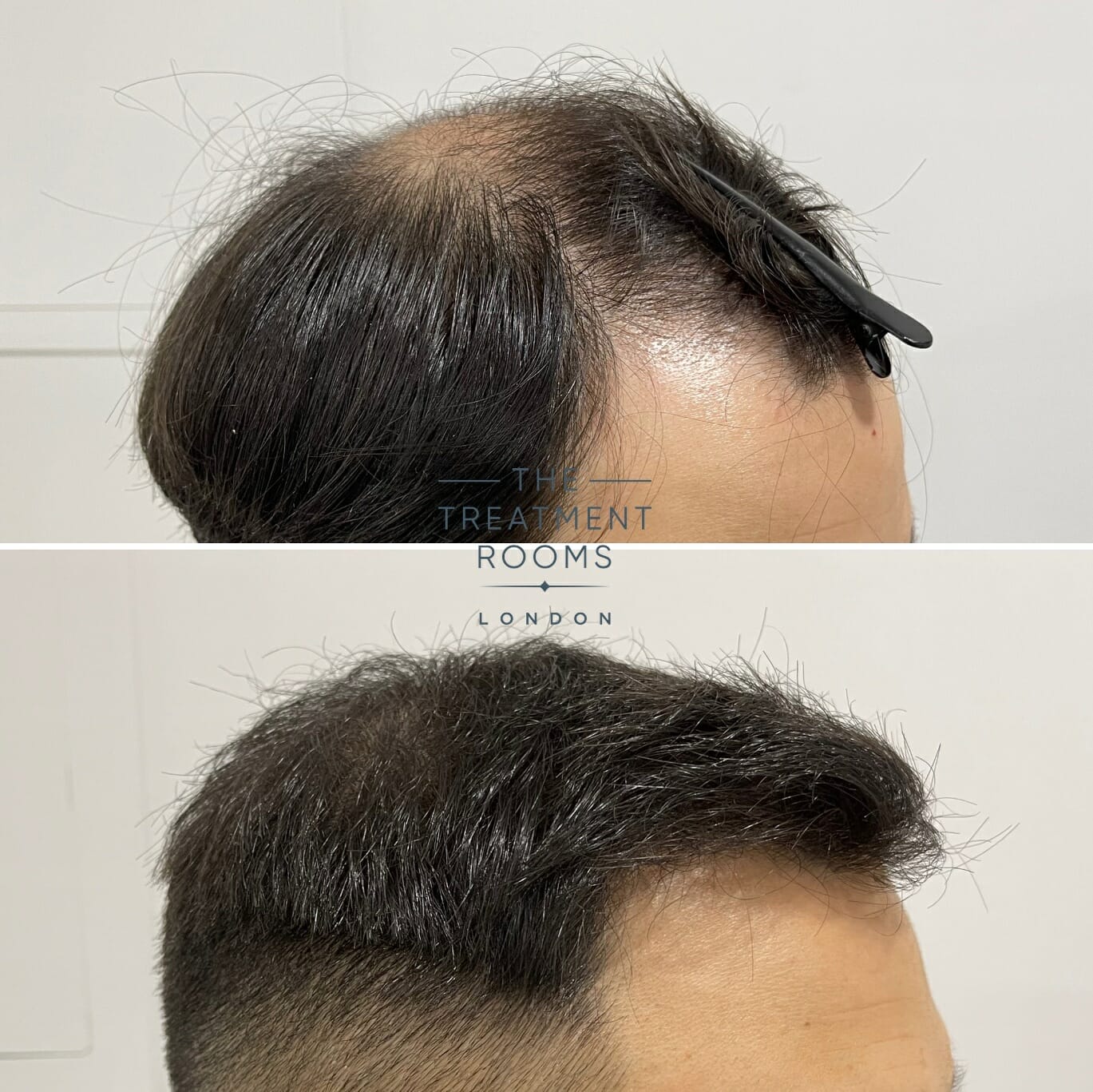 Hair transplant result 2000 grafts