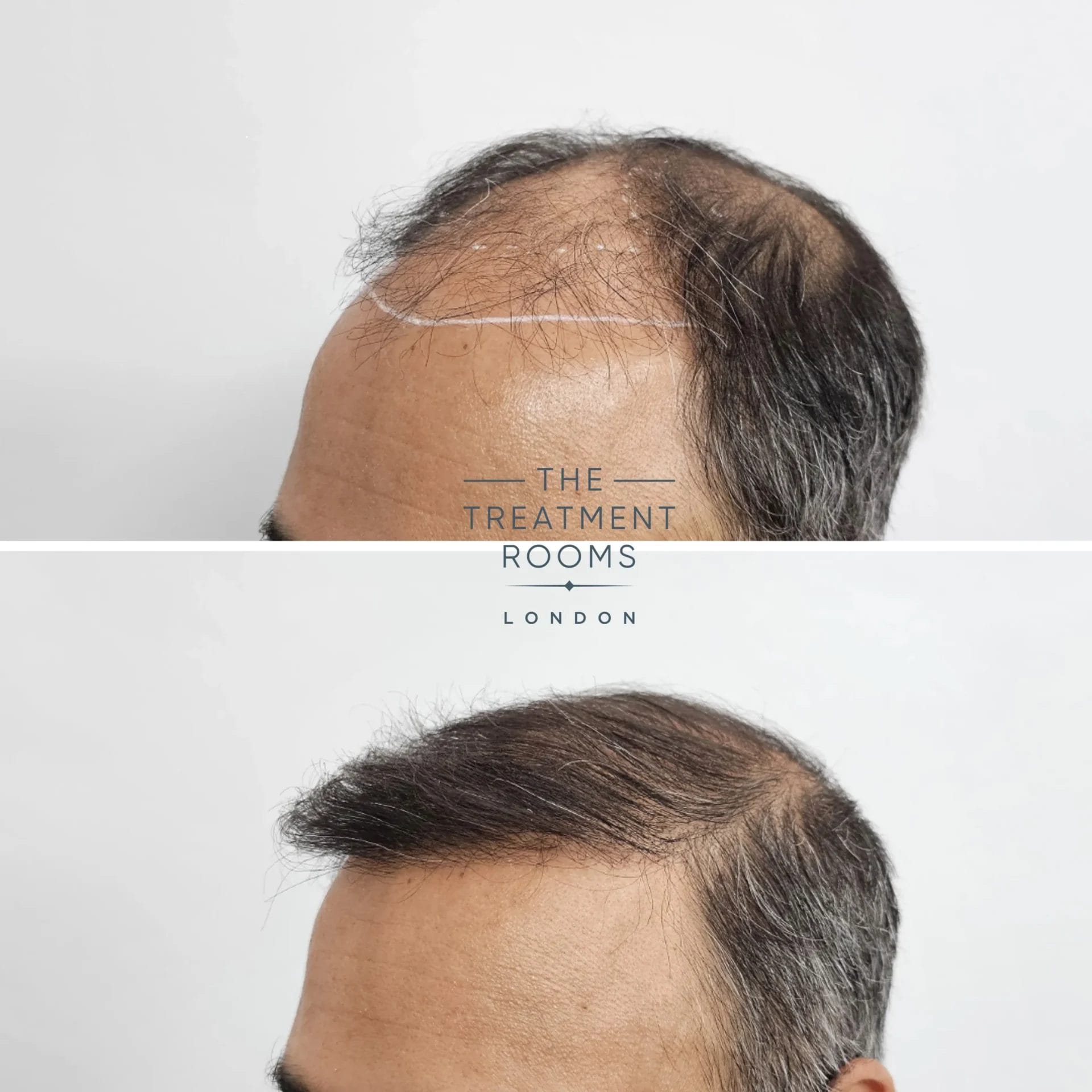 Hair transplant result before and after 2067 grafts
