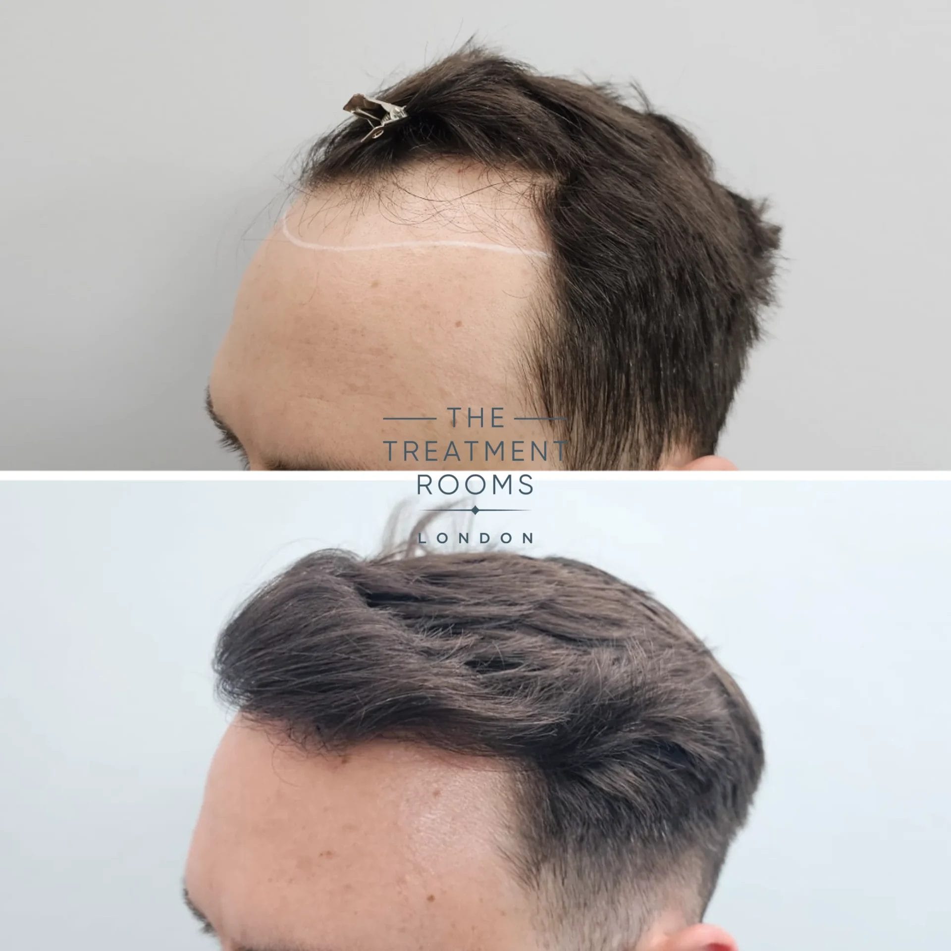 Hair transplant result before and after 2247 grafts