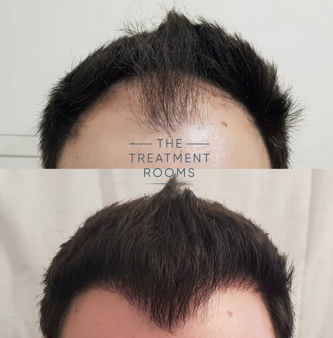Hairline FUE Hair Transplant