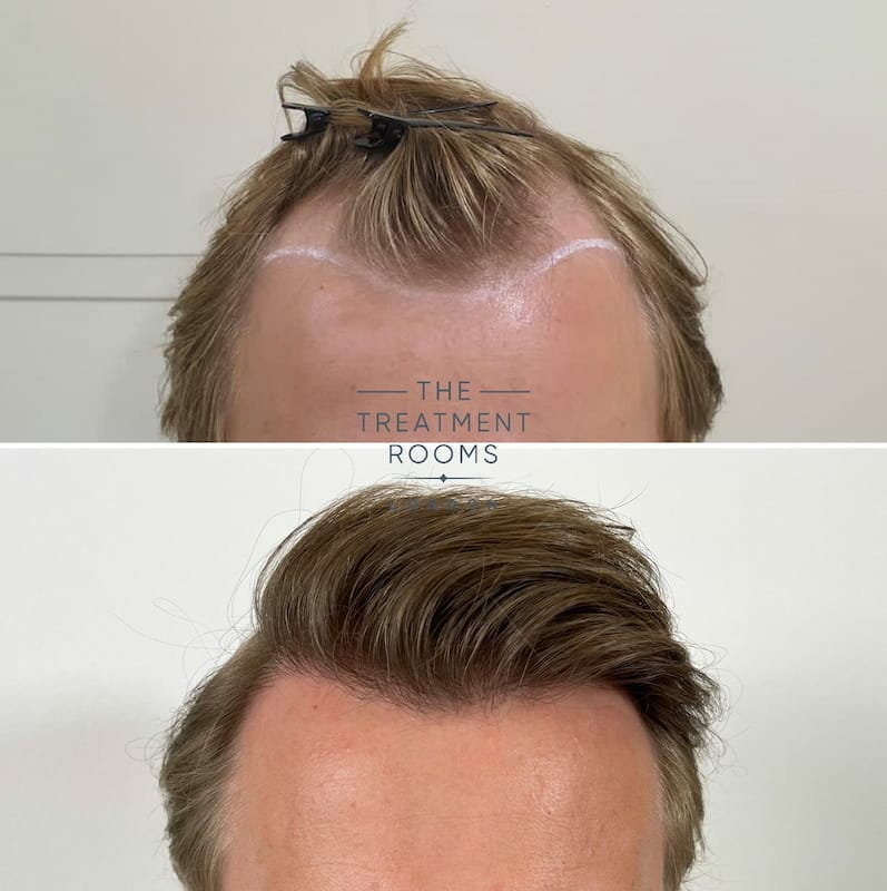 Hairline FUE hair transplant