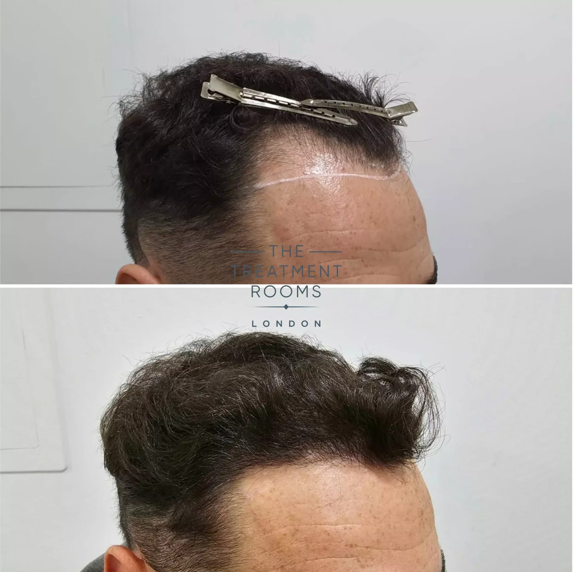 Hairline hair transplant 1303 grafts before and after Hairline hair transplant 1303 grafts before and after