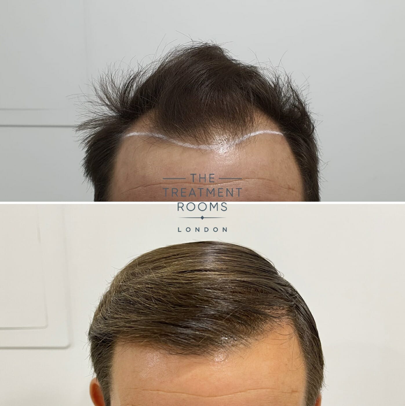 Hairline hair transplant