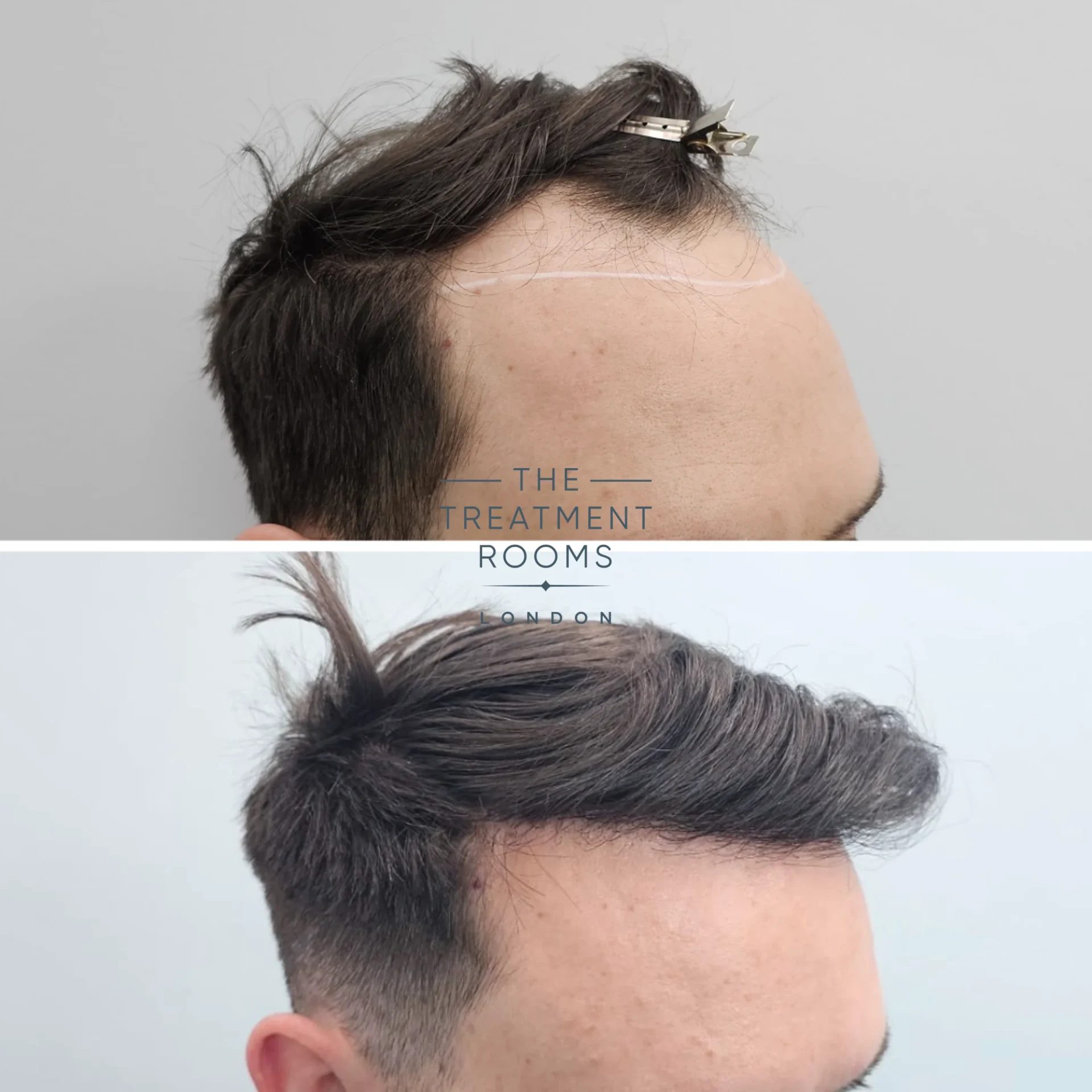 Hairline transplant before and after 2247 grafts