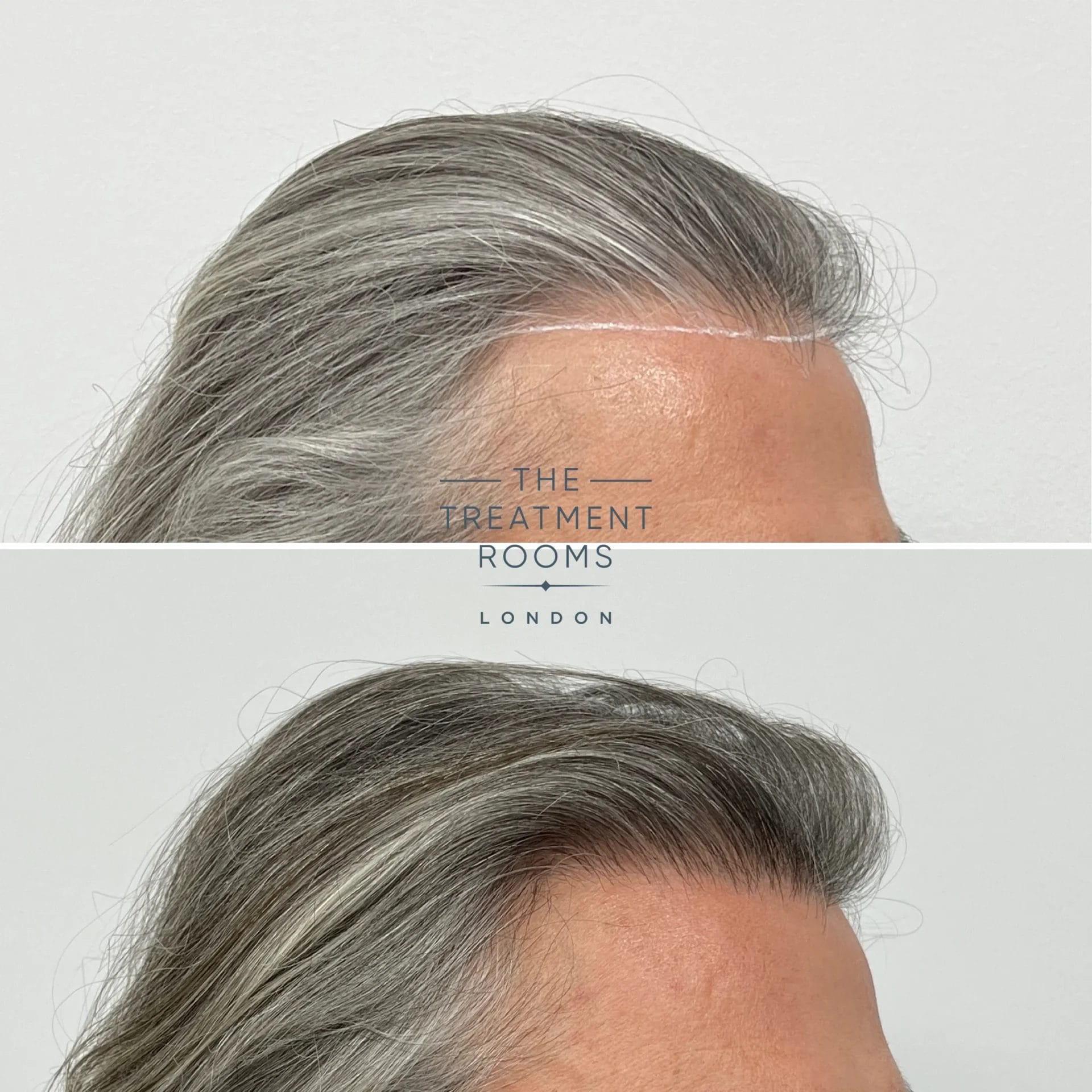 Hairline transplant before and after 907 grafts