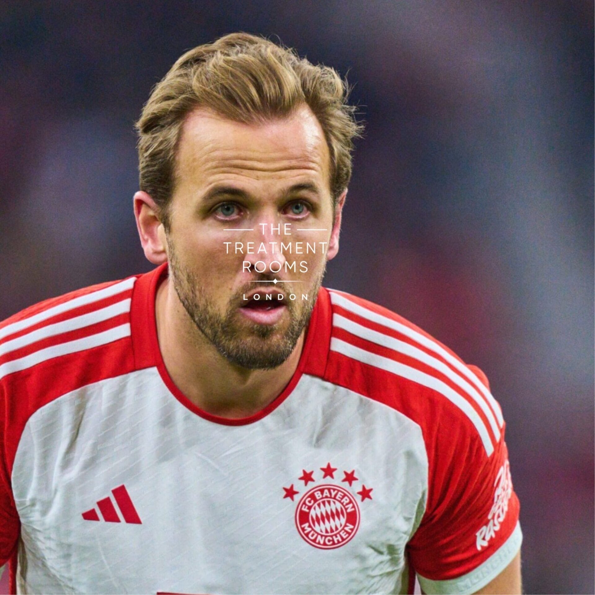 harry kane hair loss