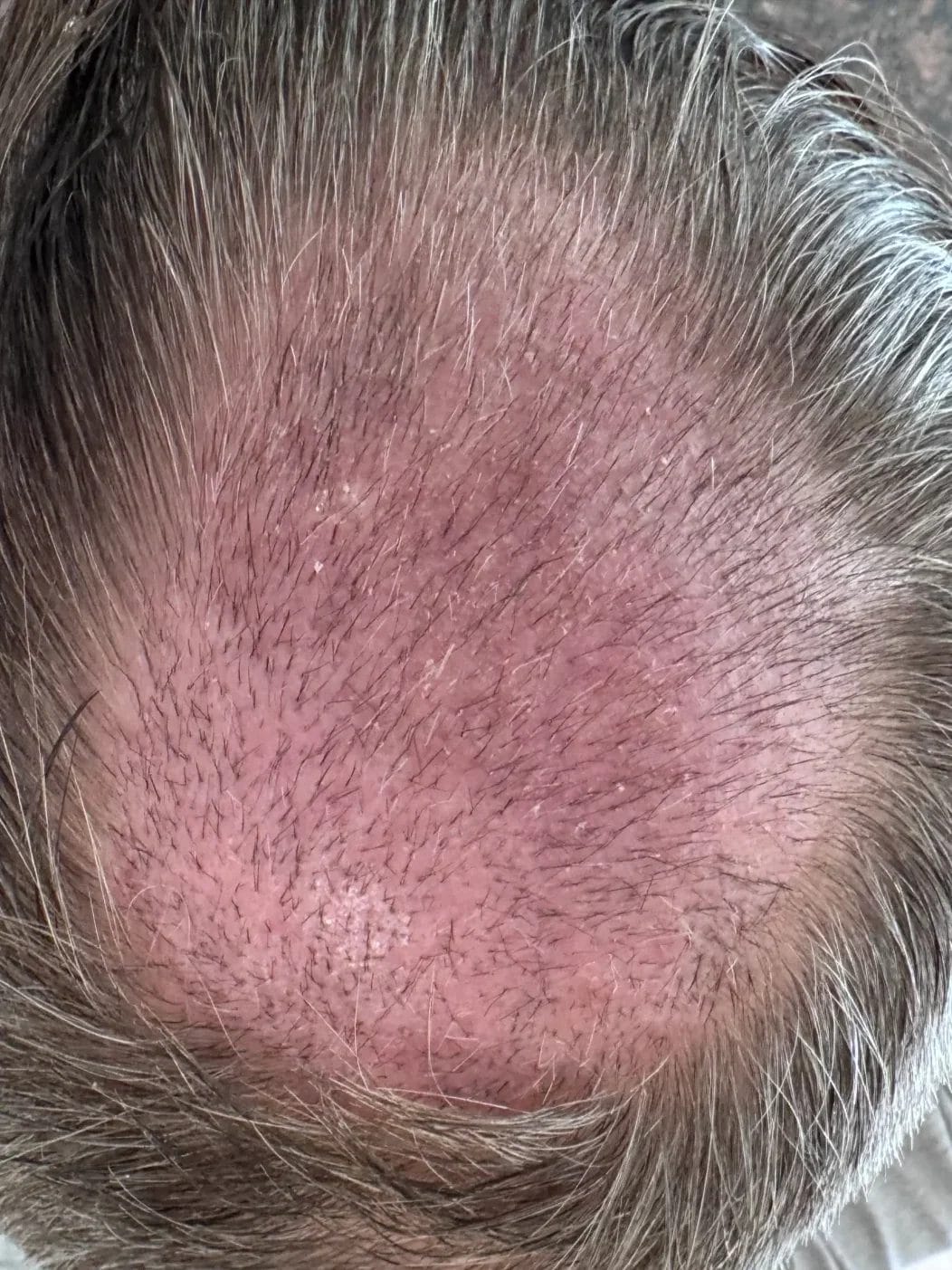 crown redness 2 weeks after surgery