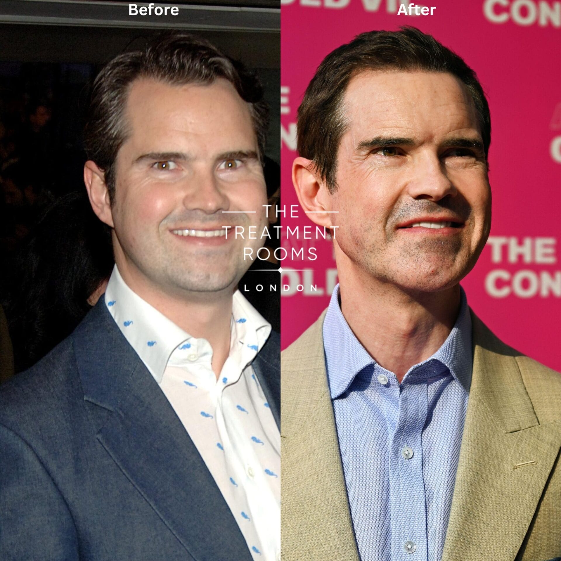 picture showing jimmy carr before and after hair transplant