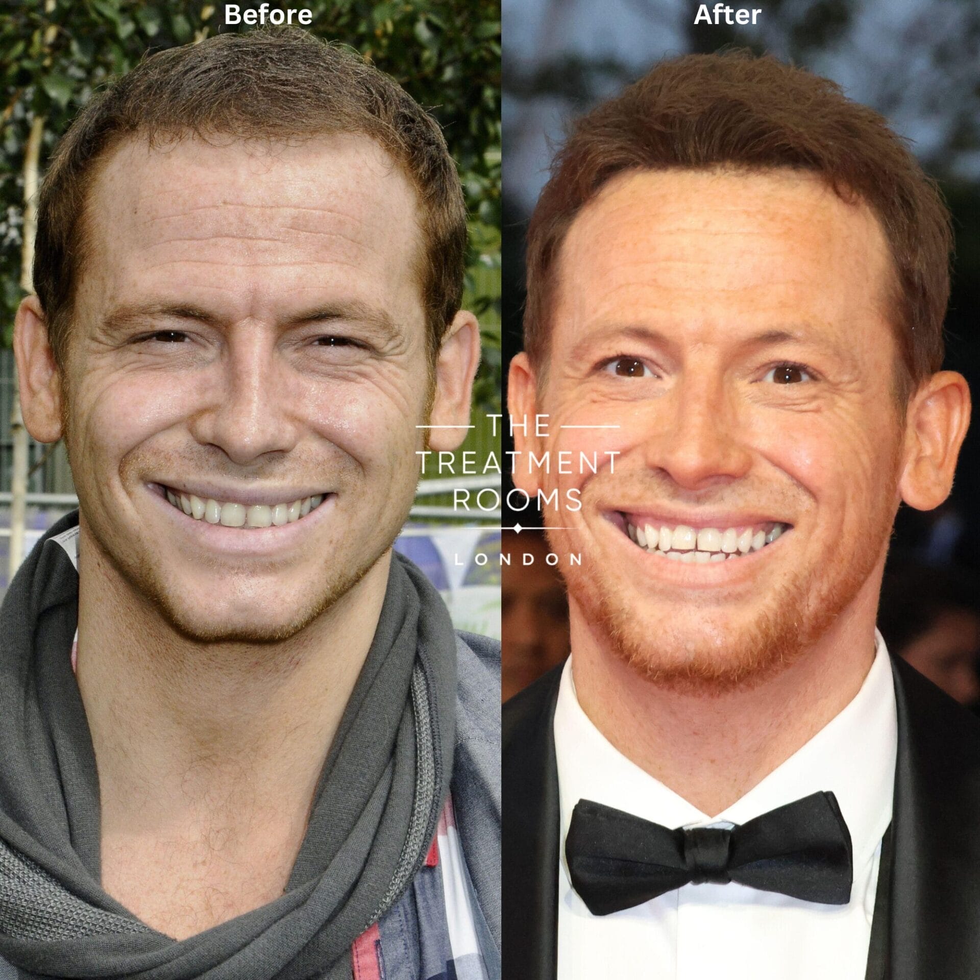 before and after picture of joe swash hair transplant procedure