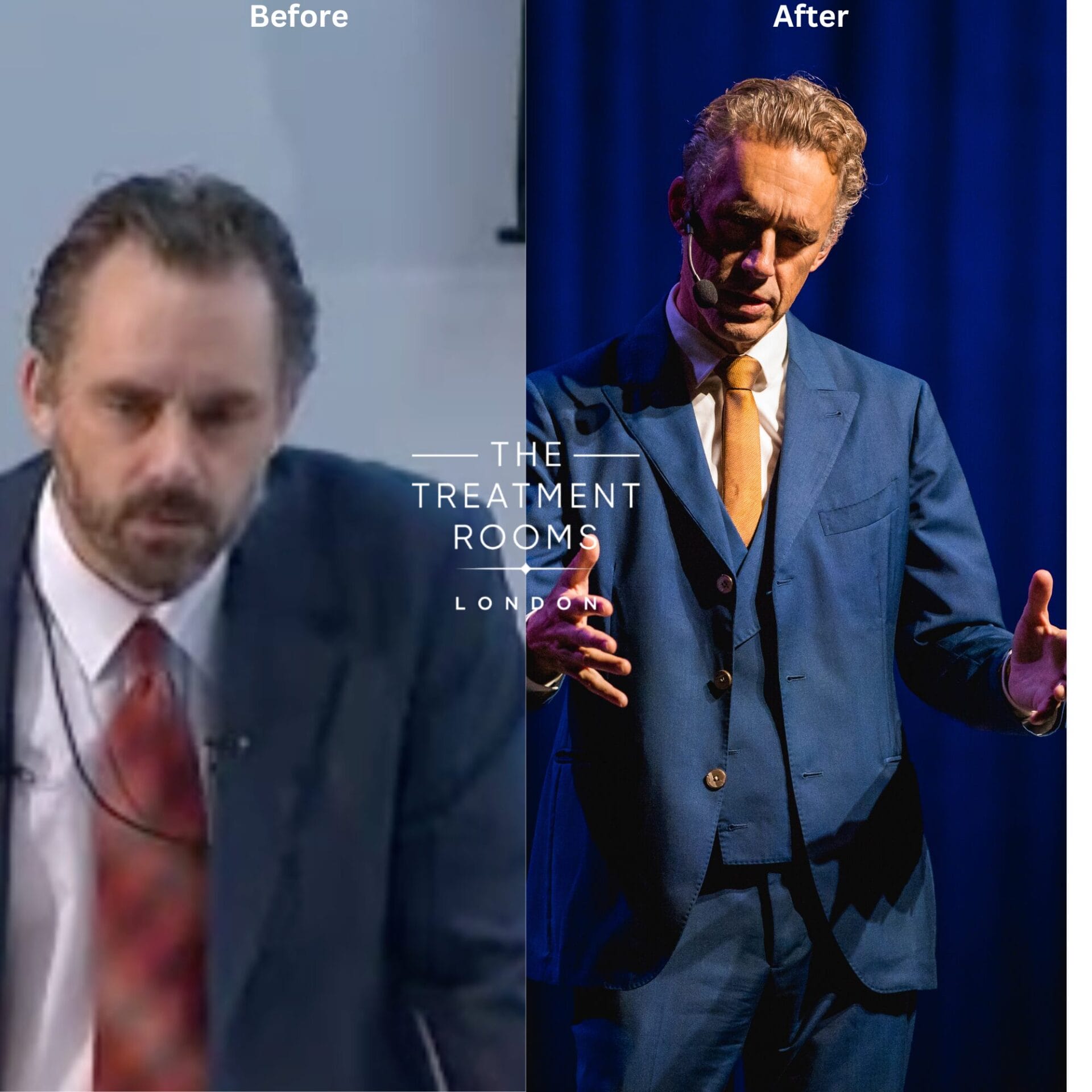 Jordan Peterson Hair Transplant Before and After