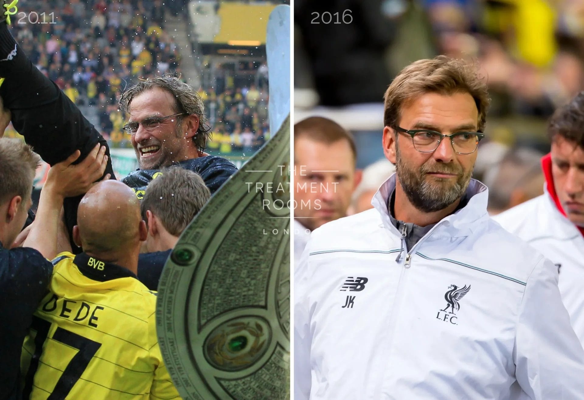 Comparison of Jurgen Klopp's hairline in 2011 before a hair transplant and in 2016 with a fuller hairline